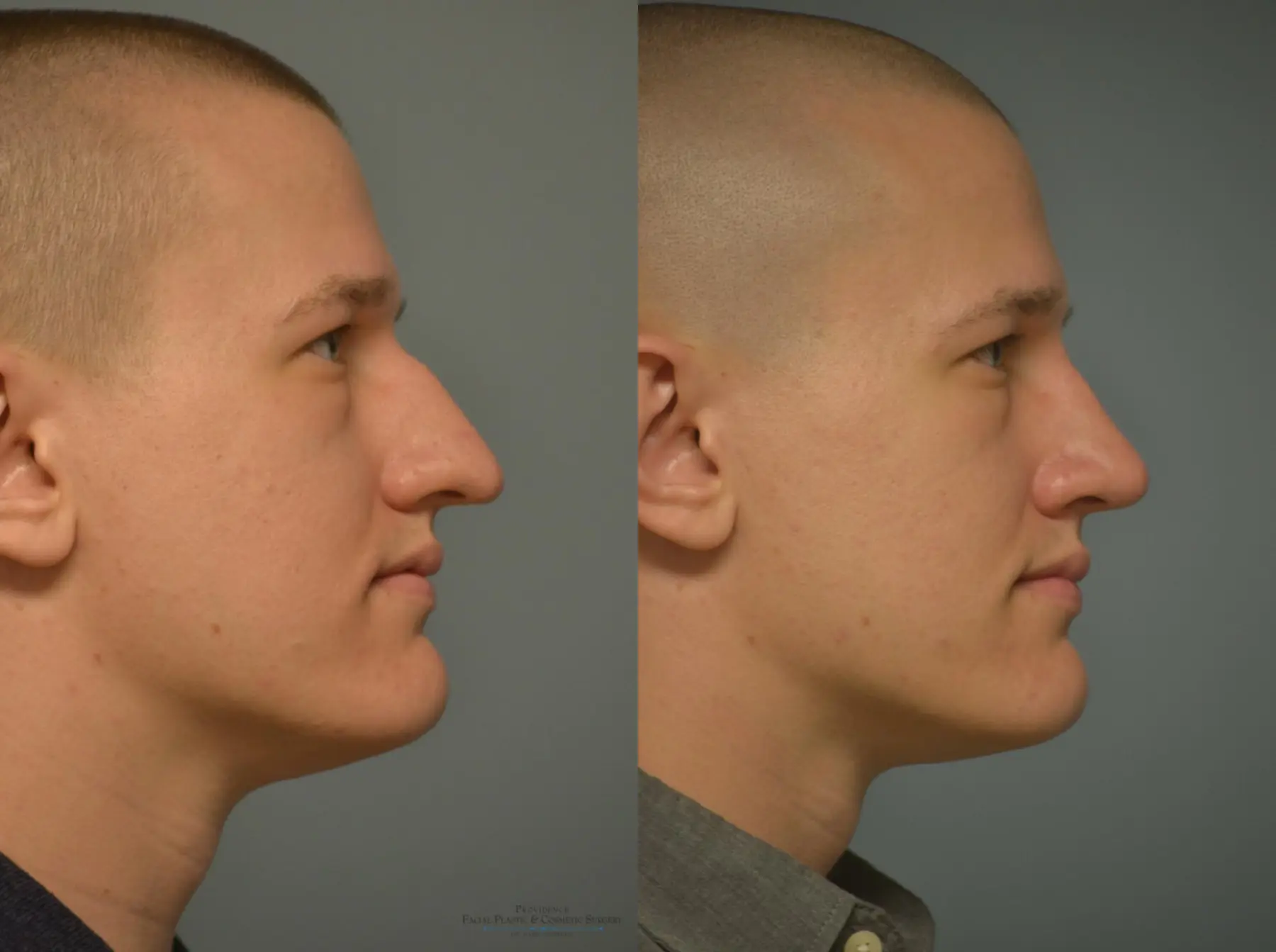 Rhinoplasty: Patient 20 - Before and After 3