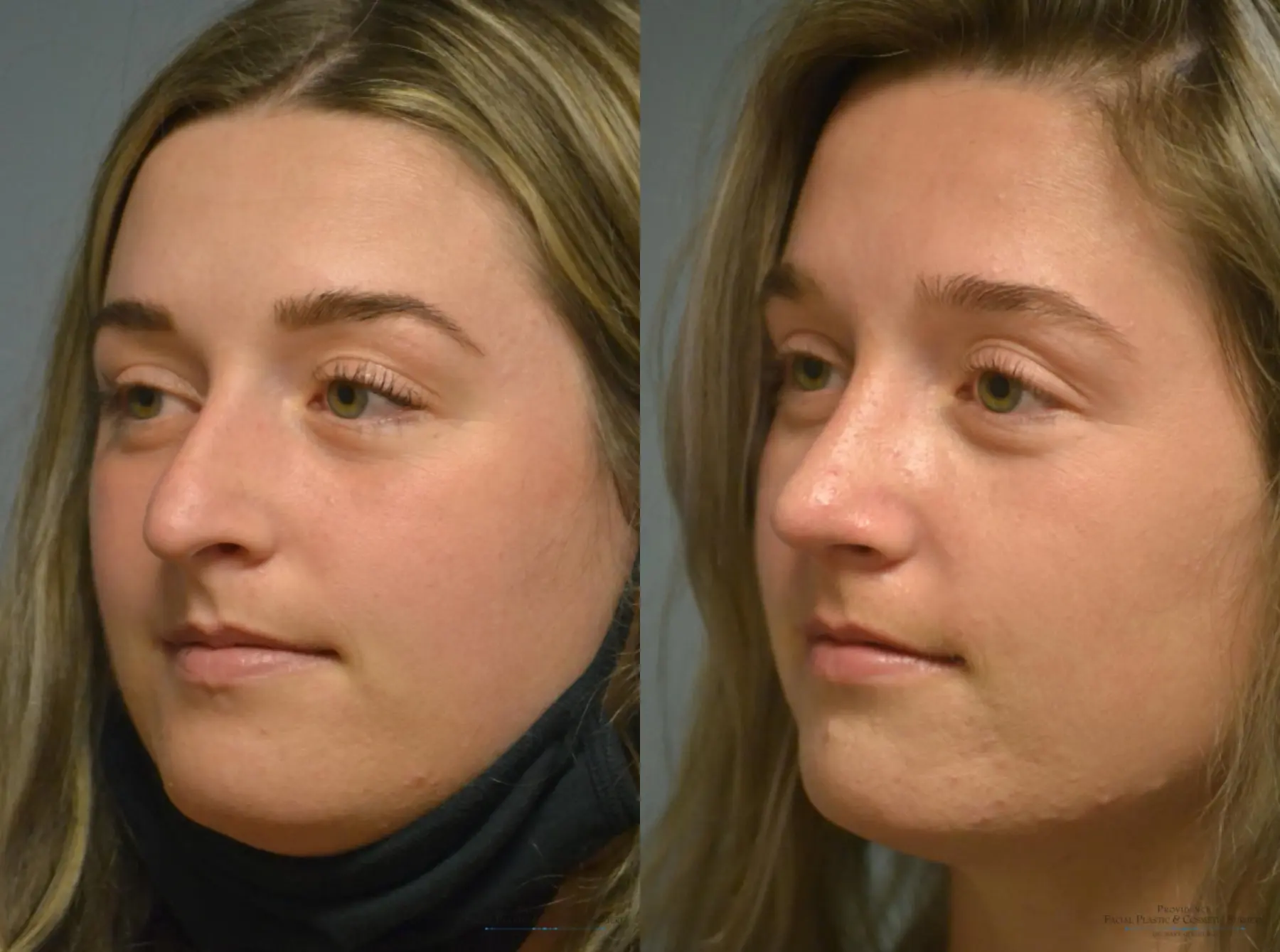 Rhinoplasty: Patient 9 - Before and After 2