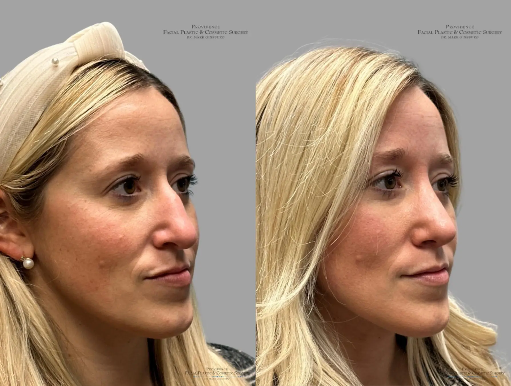 Rhinoplasty: Patient 34 - Before and After 3