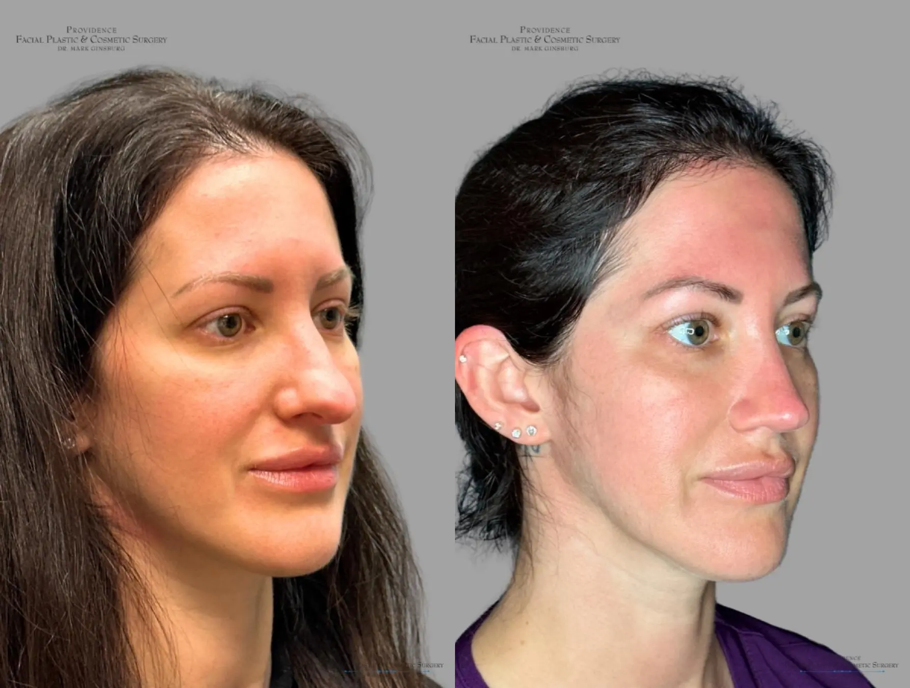 Rhinoplasty: Patient 33 - Before and After 3