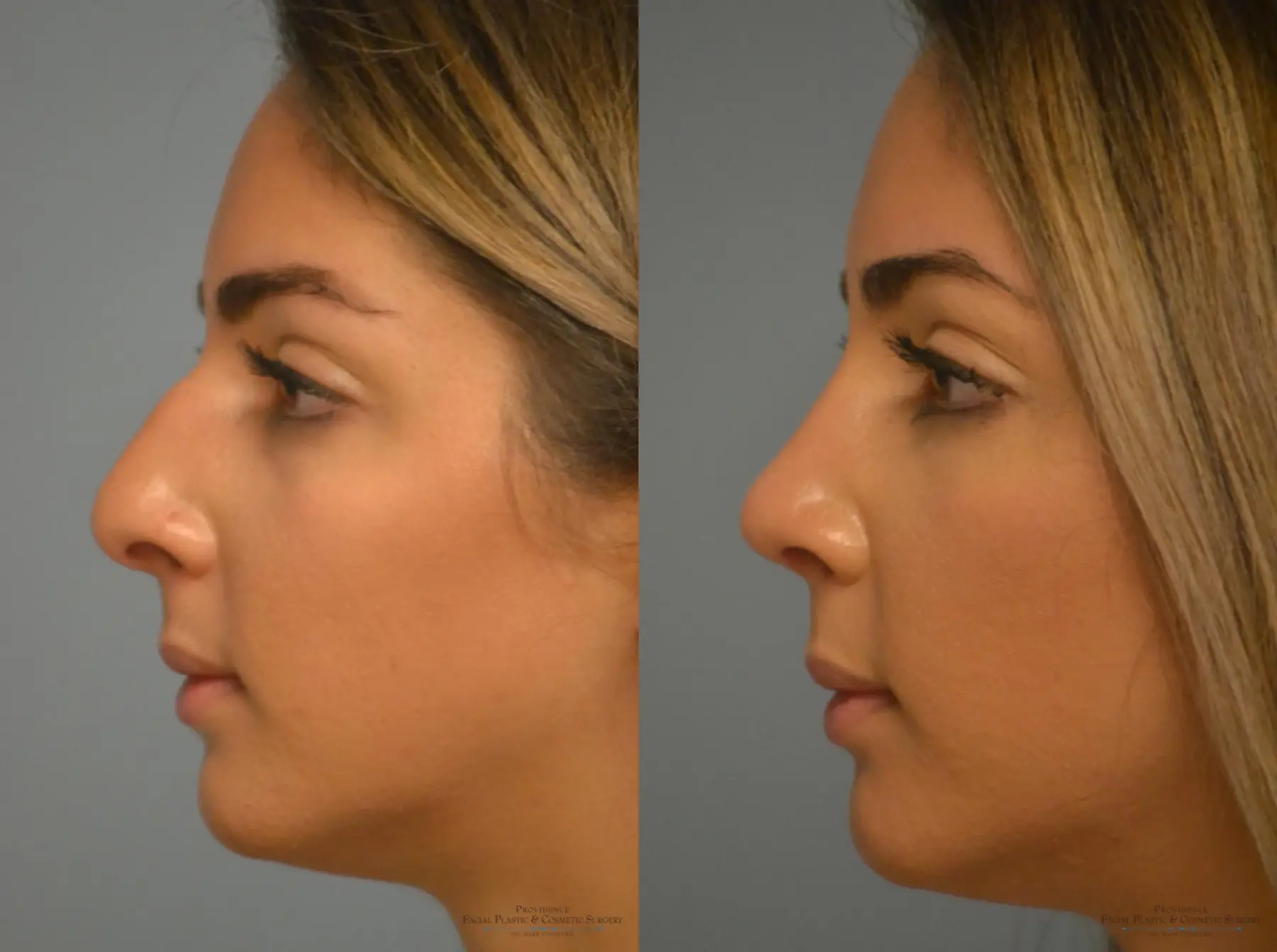 Rhinoplasty: Patient 10 - Before and After 3
