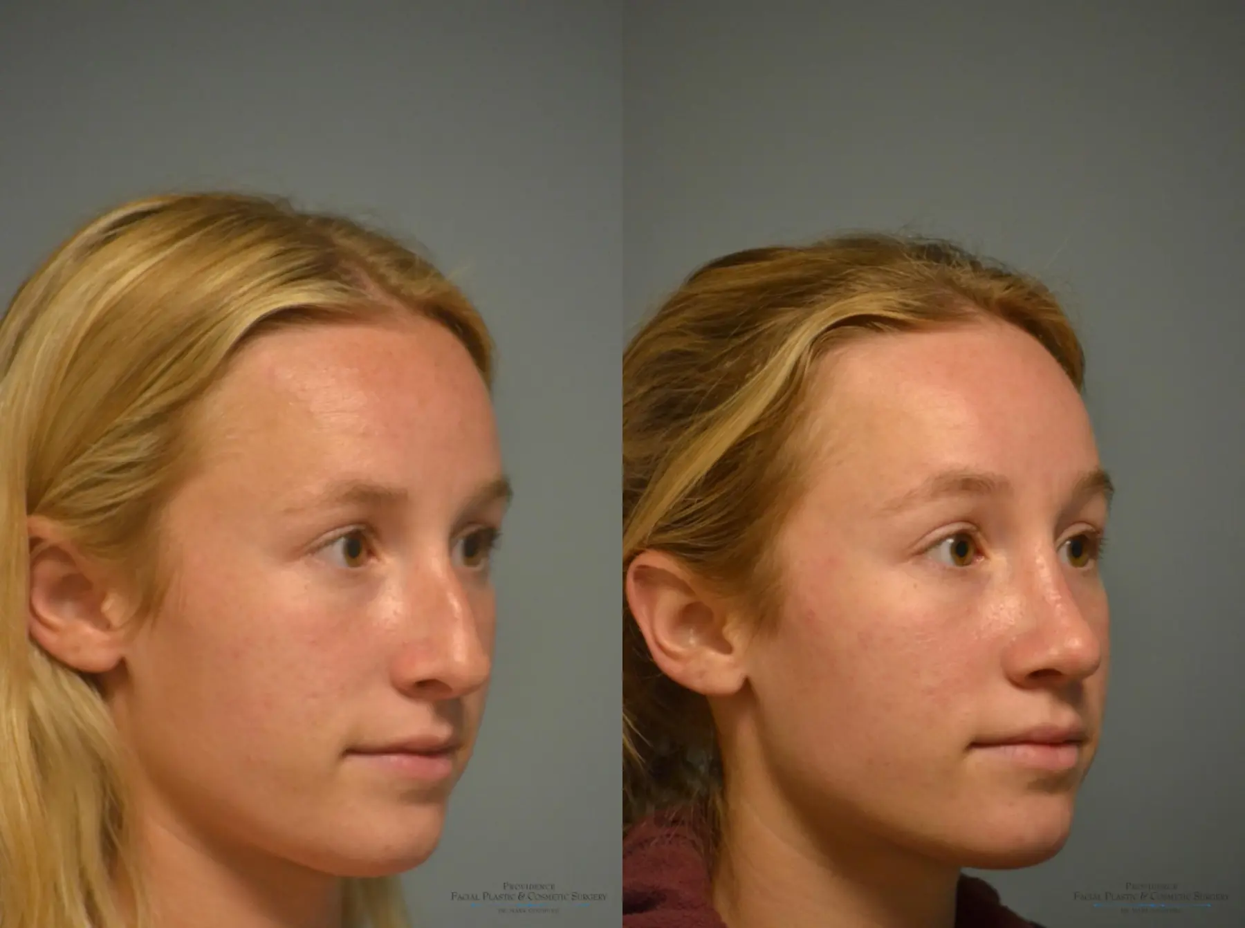 Rhinoplasty: Patient 22 - Before and After 4