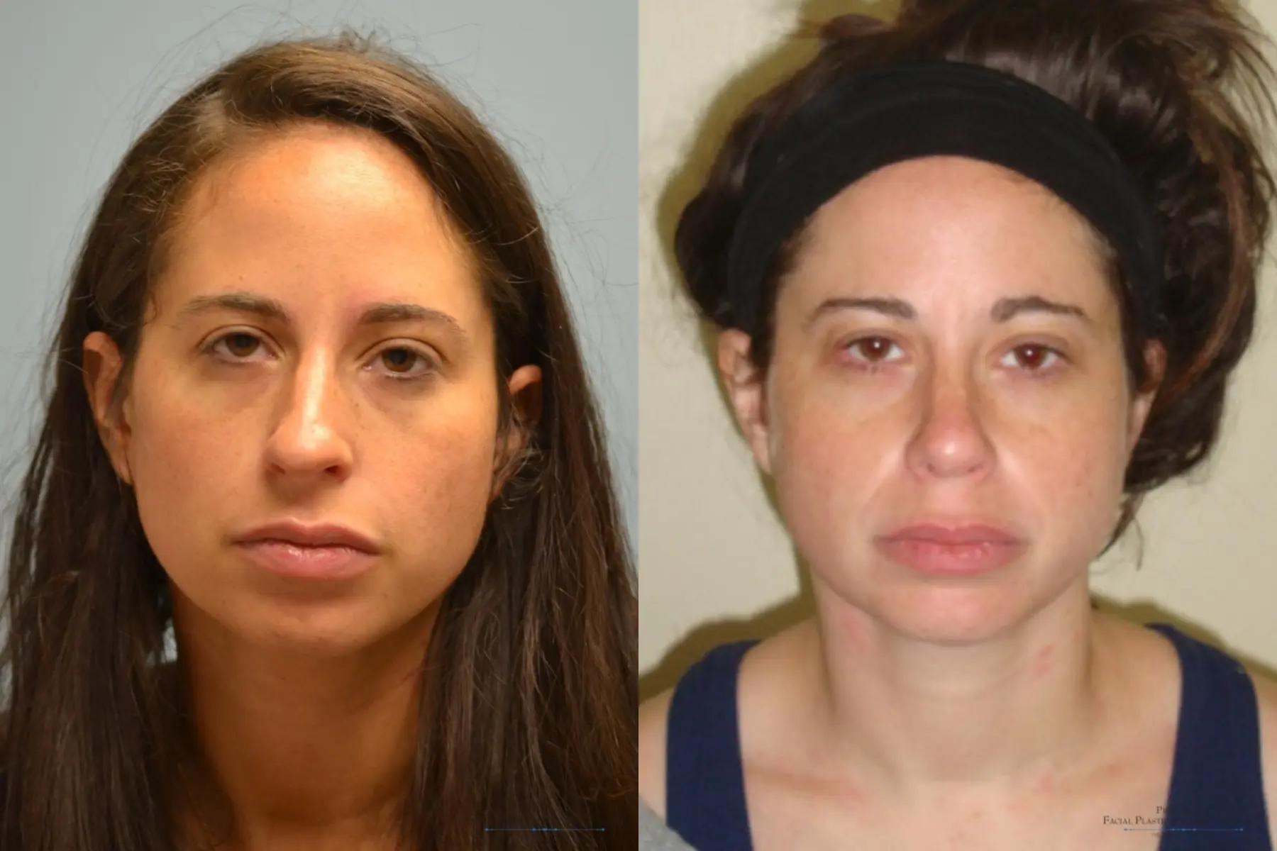 Rhinoplasty: Patient 3 - Before and After 1