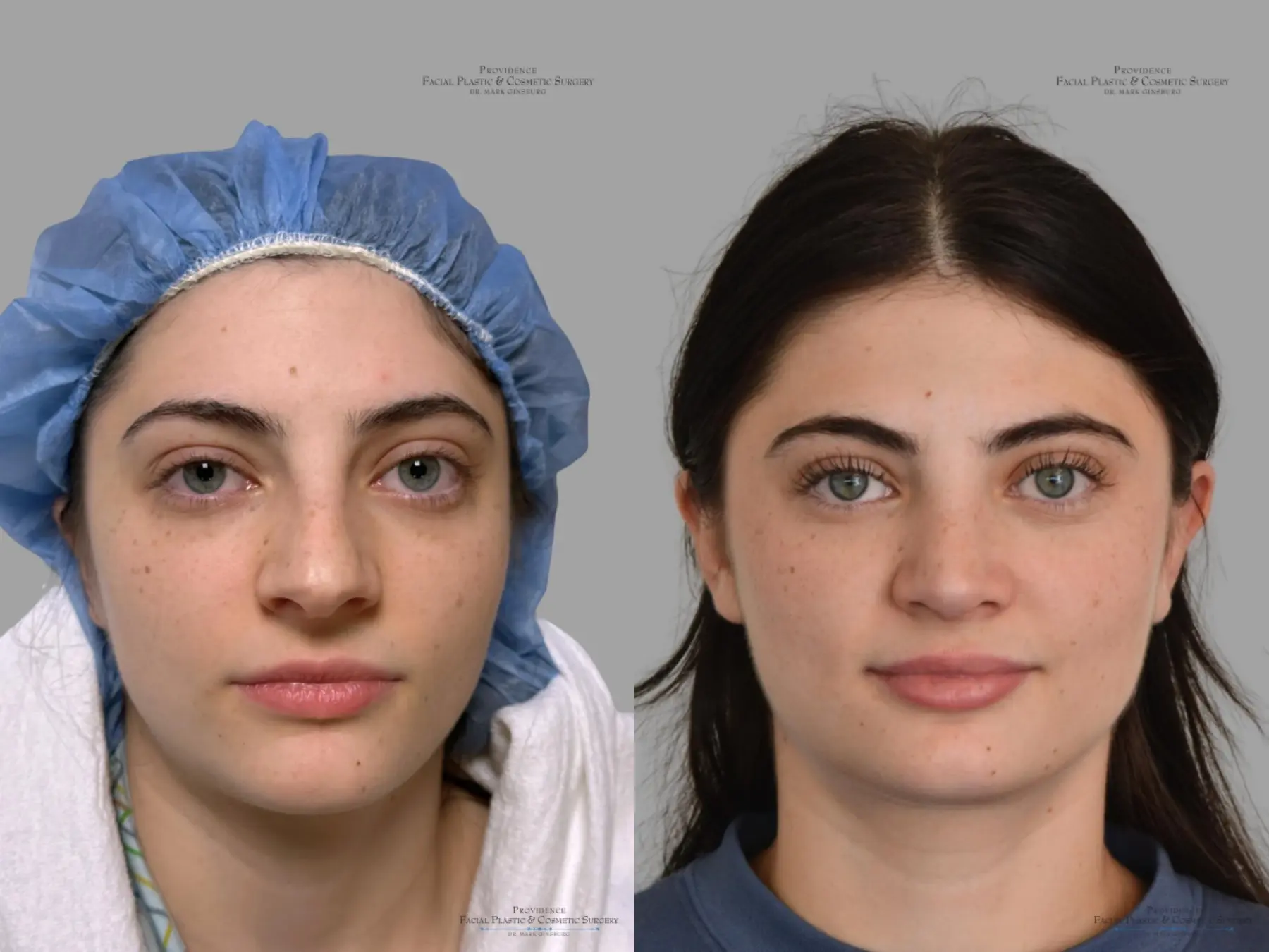 Rhinoplasty: Patient 43 - Before and After 1