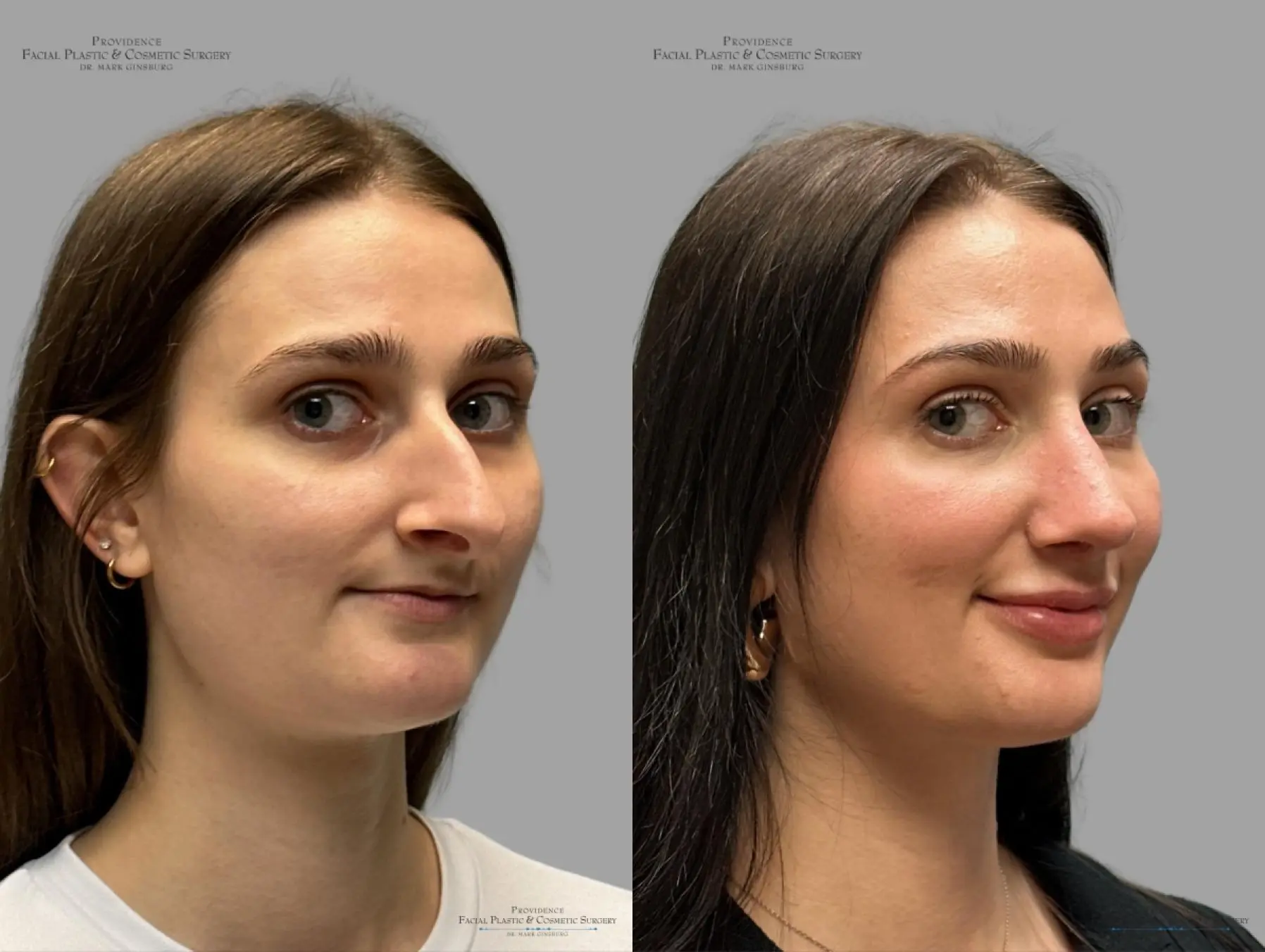 Rhinoplasty: Patient 32 - Before and After 2