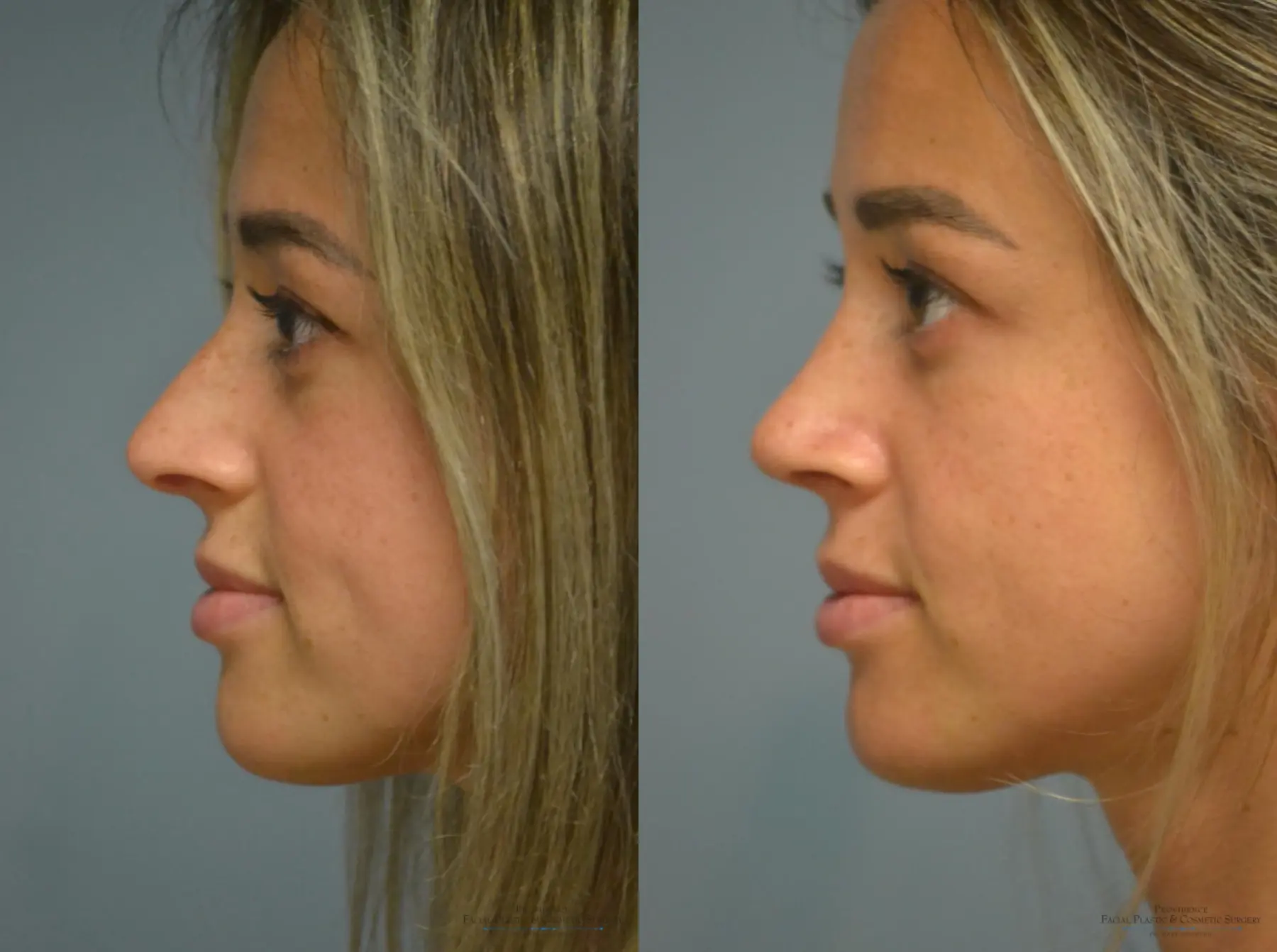 Rhinoplasty: Patient 9 - Before and After 2