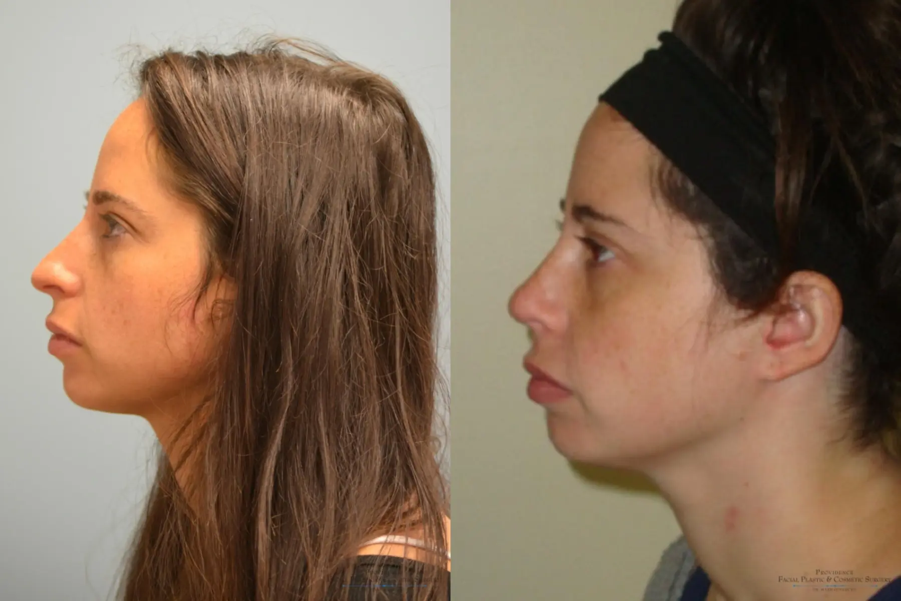 Rhinoplasty: Patient 3 - Before and After 4