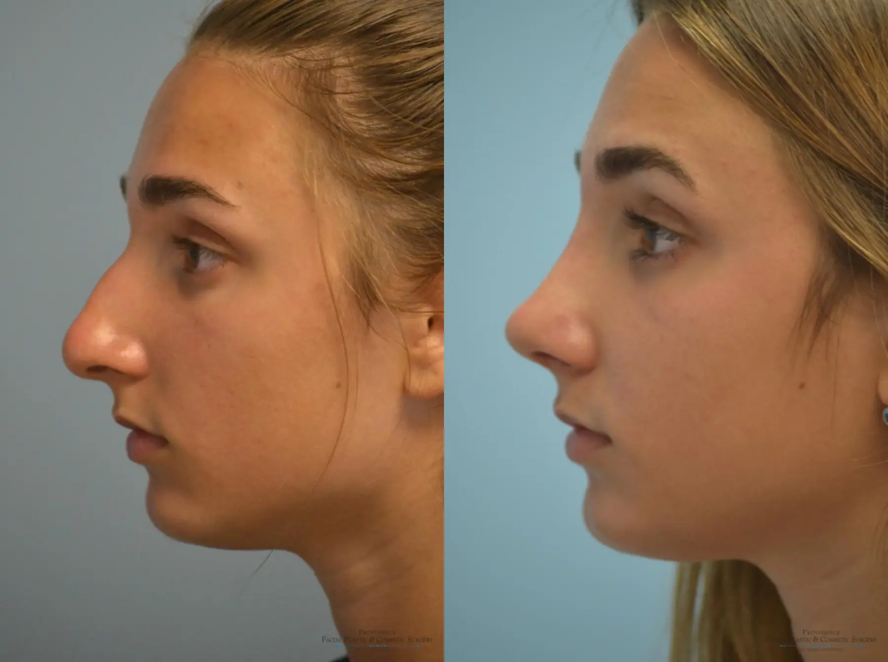 Rhinoplasty: Patient 8 - Before and After 3