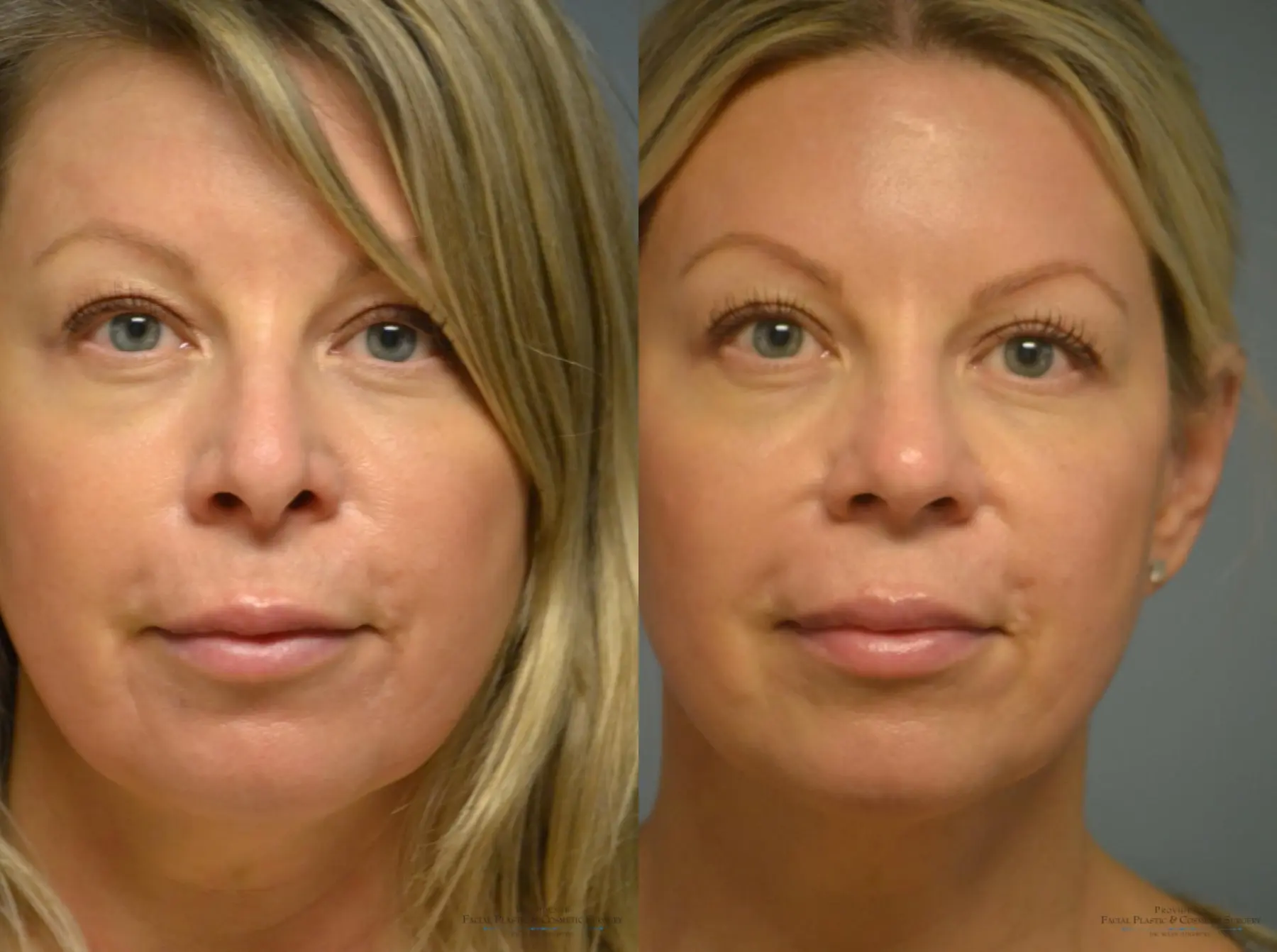 Rhinoplasty: Patient 4 - Before and After 1