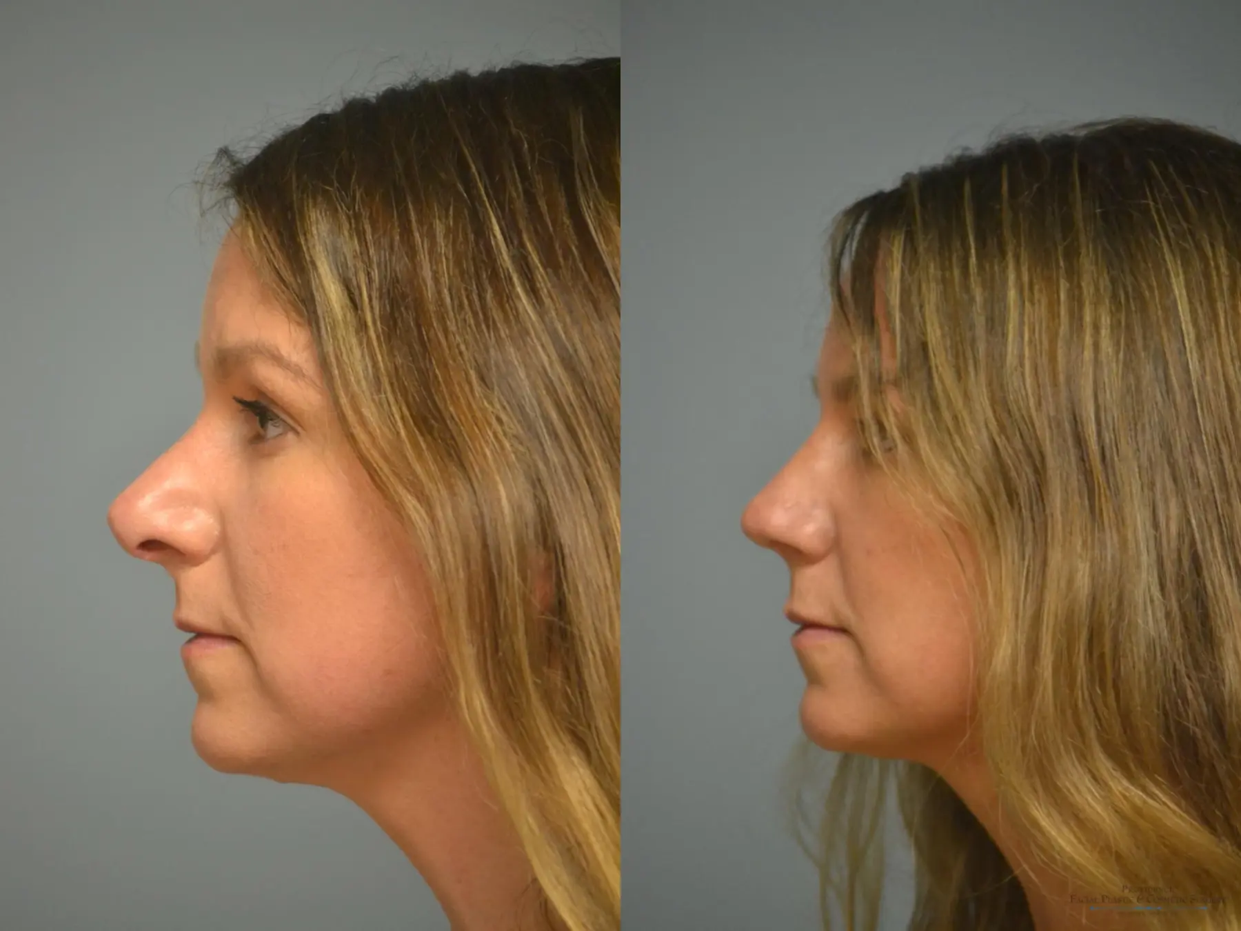 Rhinoplasty: Patient 13 - Before and After 2