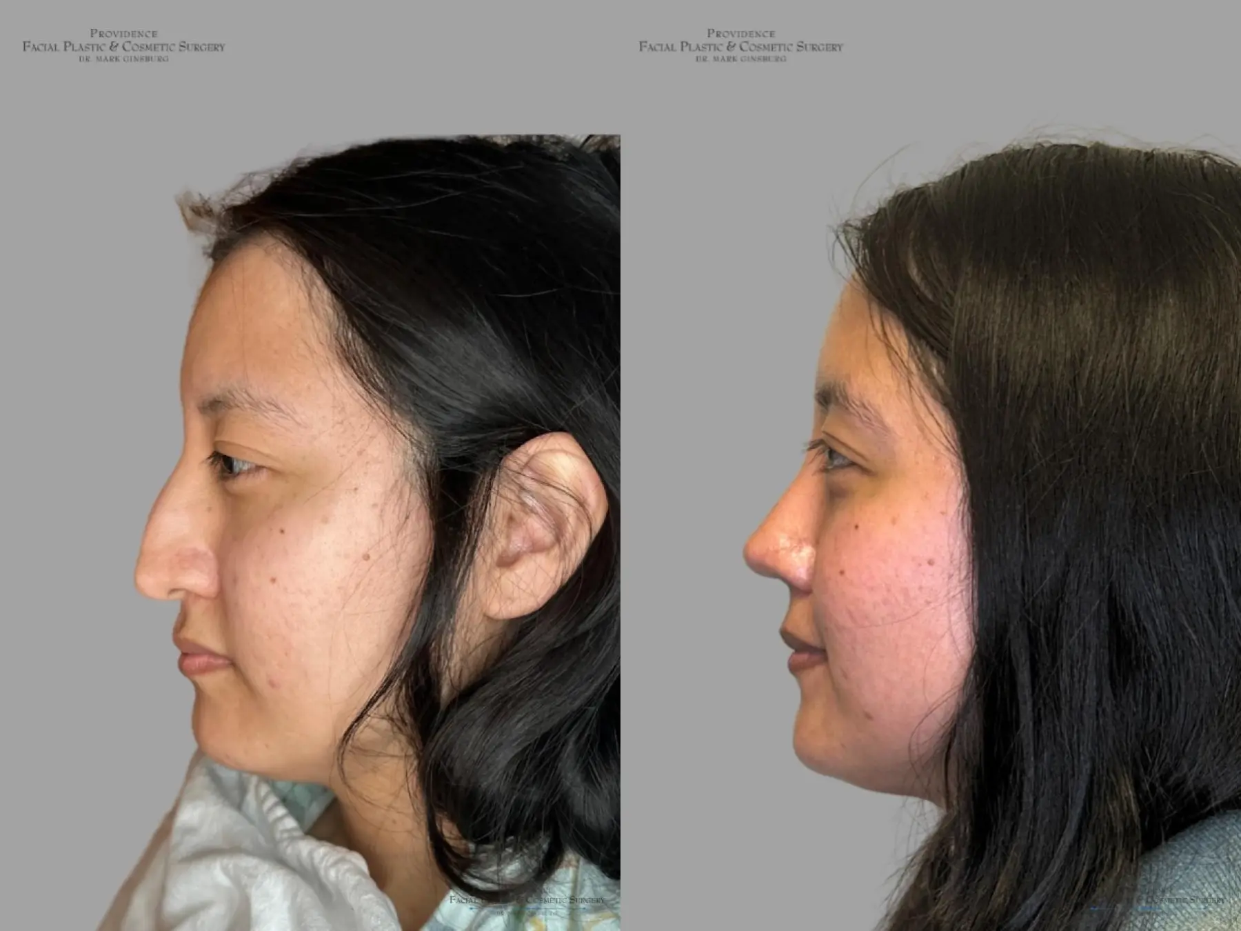 Rhinoplasty: Patient 31 - Before and After 5