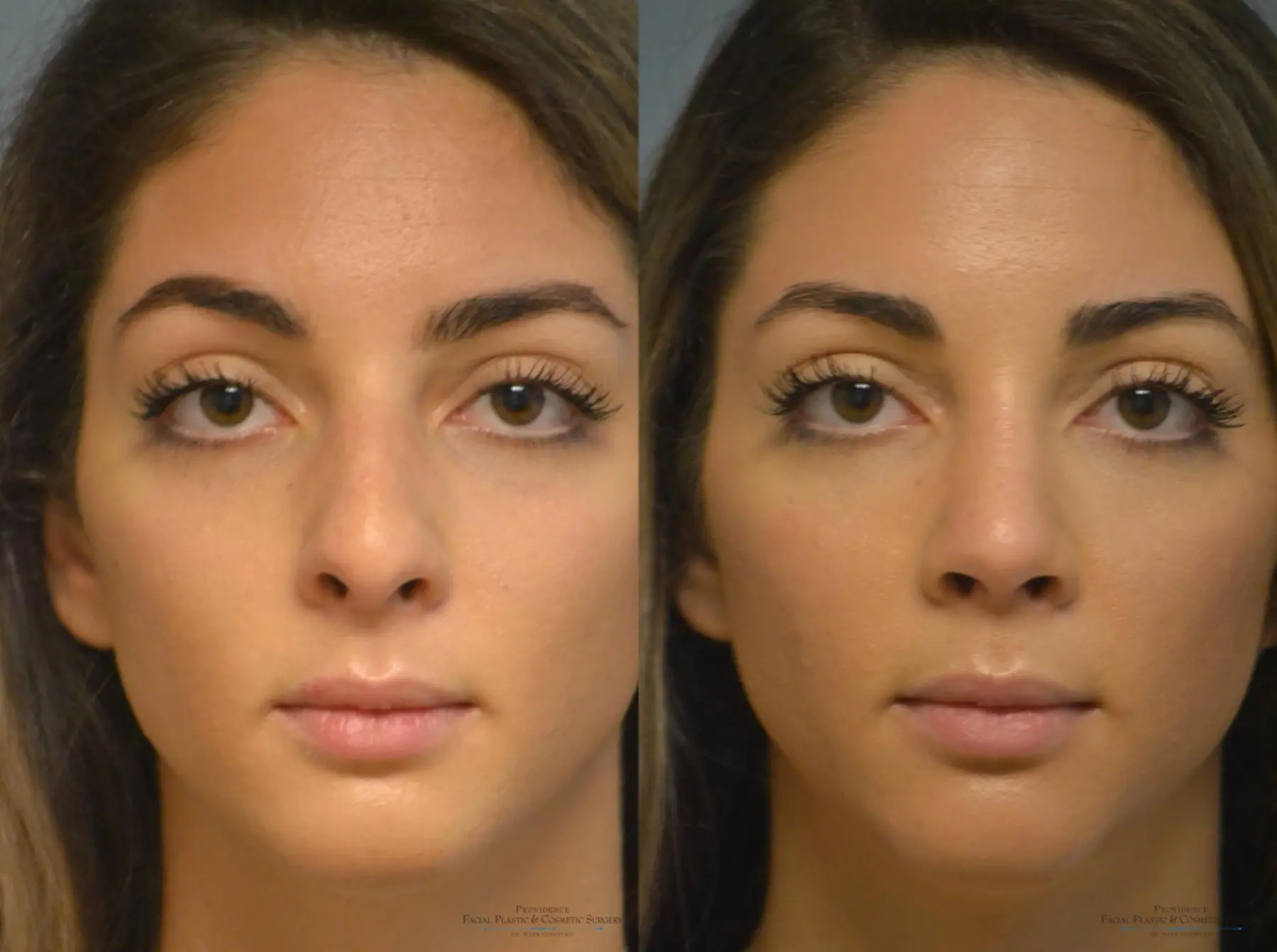 Rhinoplasty: Patient 10 - Before and After 1