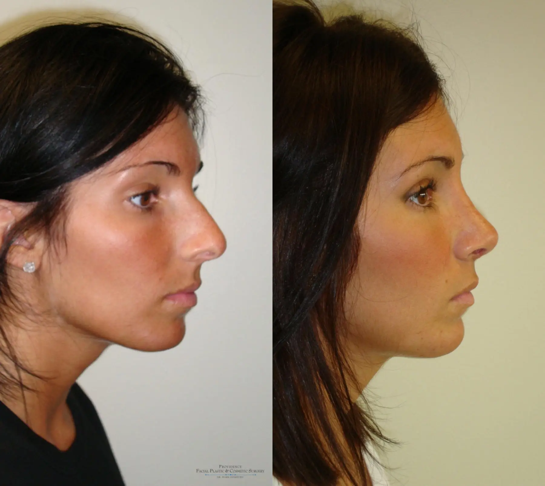 Rhinoplasty: Patient 11 - Before and After 3