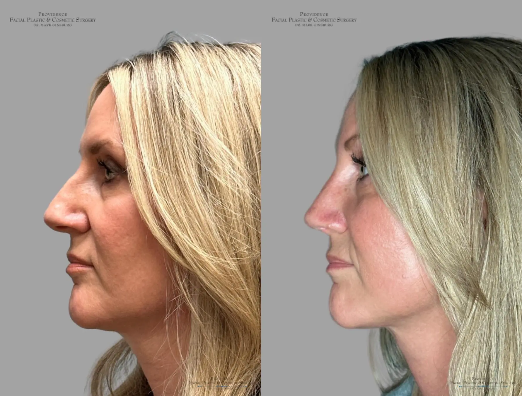 Rhinoplasty: Patient 38 - Before and After 6