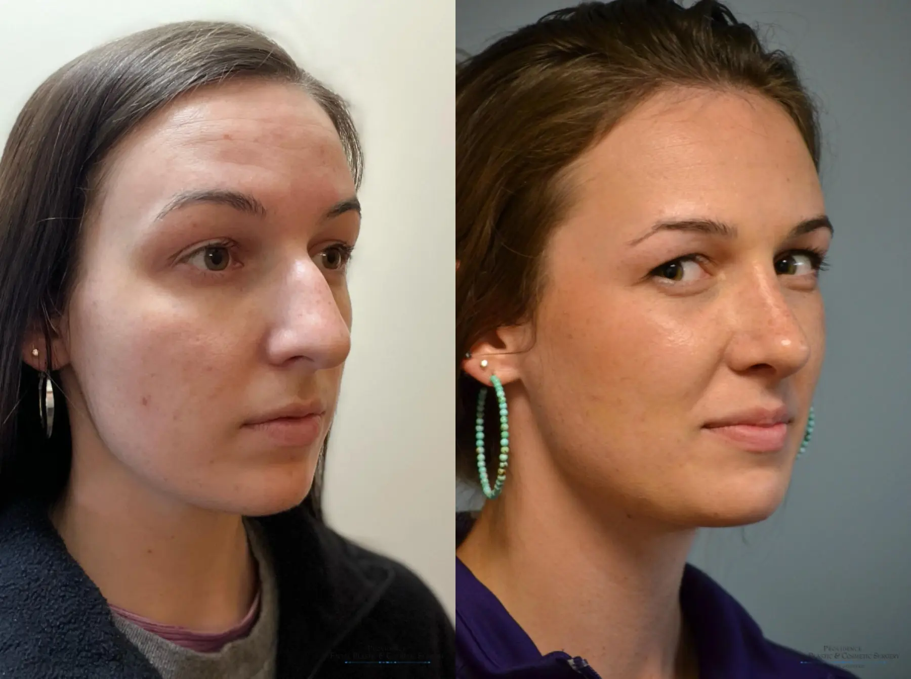 Rhinoplasty: Patient 42 - Before and After 1