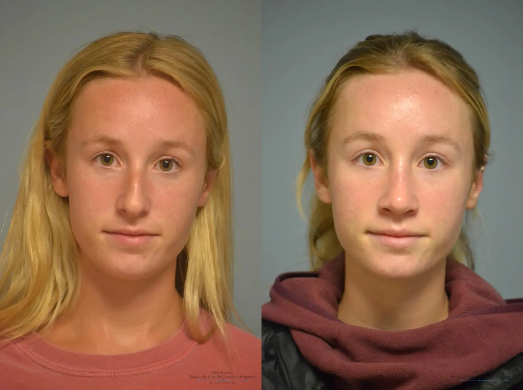 Rhinoplasty: Patient 22 - Before and After 1