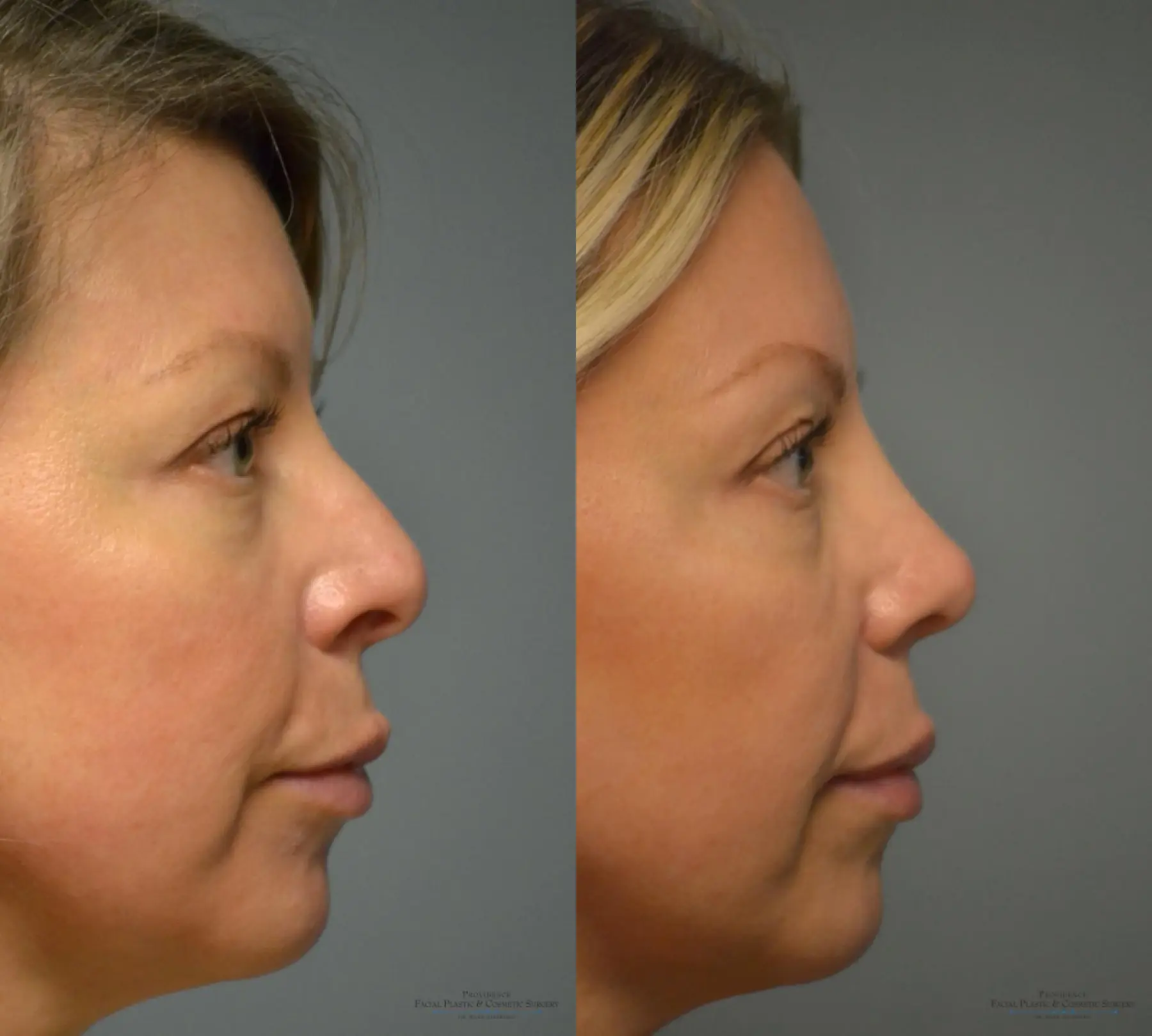 Rhinoplasty: Patient 4 - Before and After 4