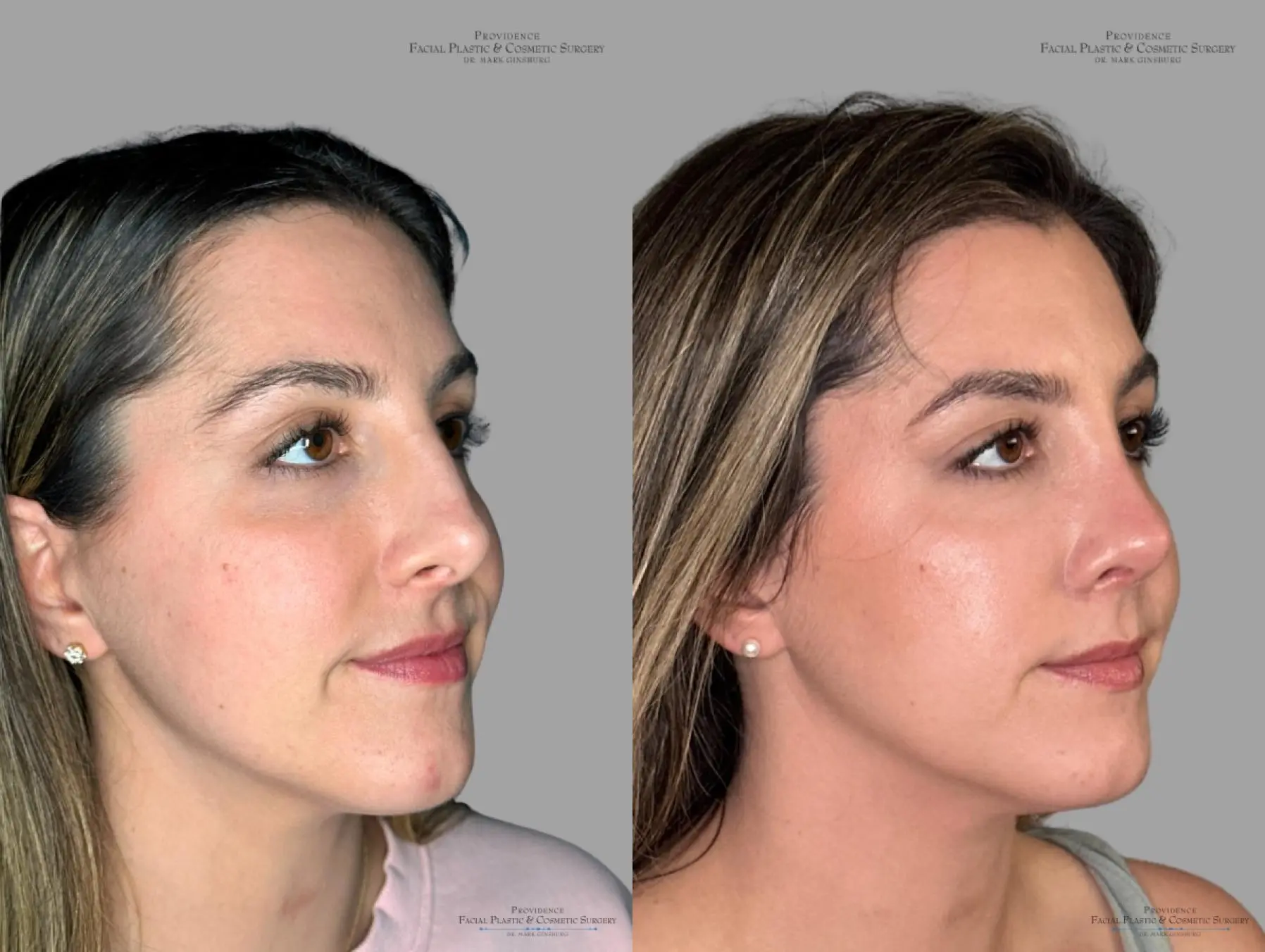 Rhinoplasty: Patient 40 - Before and After 2