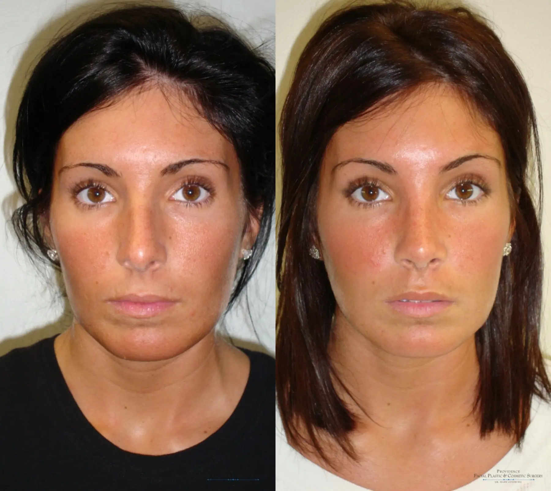 Rhinoplasty: Patient 11 - Before and After 1