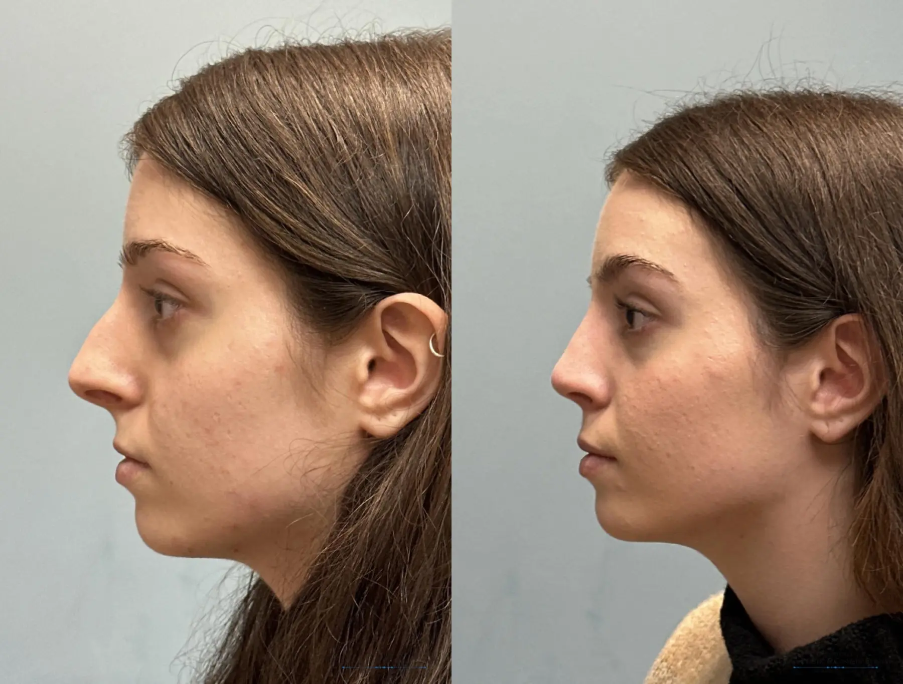 Rhinoplasty: Patient 36 - Before and After 2