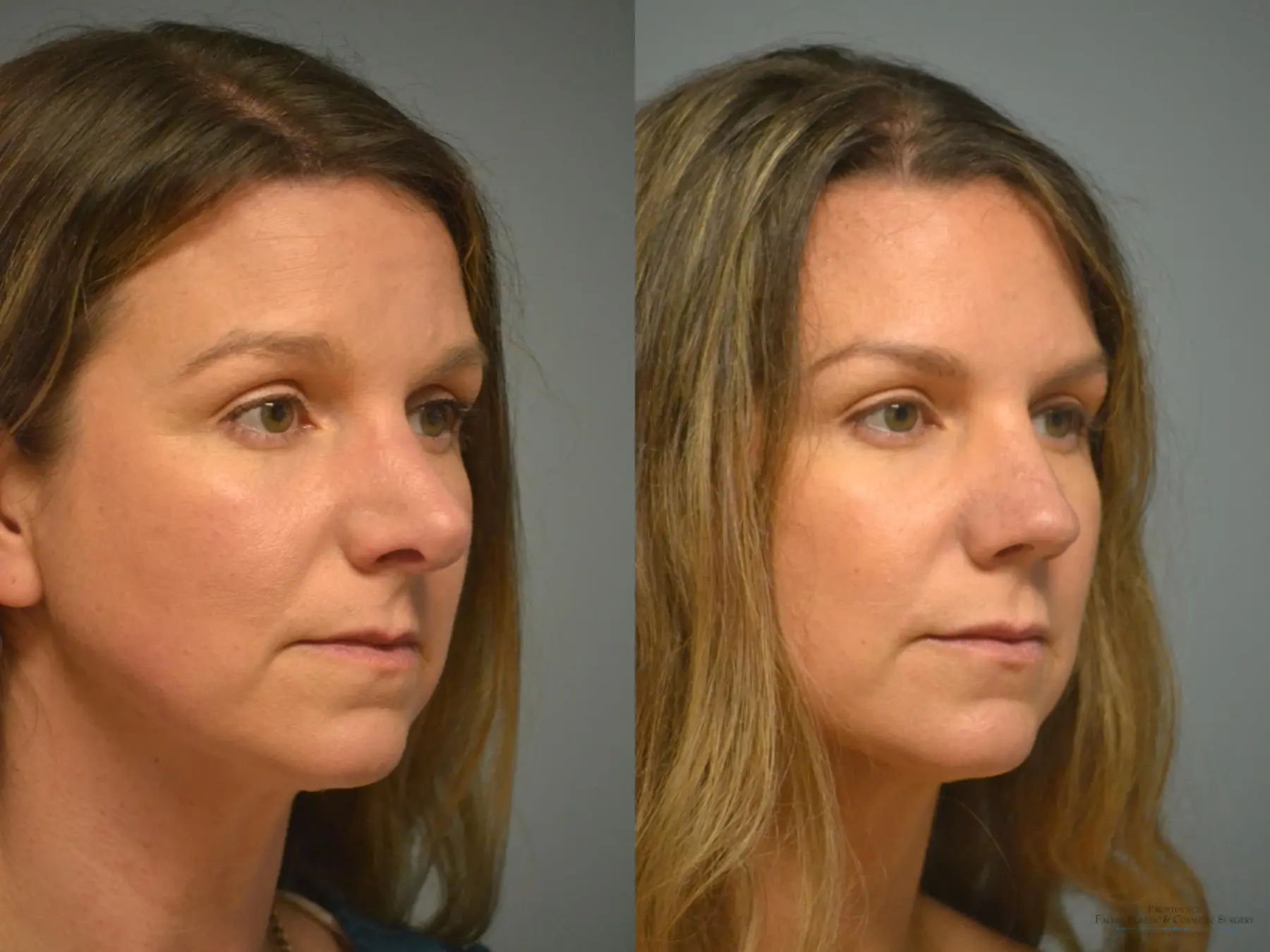 Rhinoplasty: Patient 13 - Before and After 3