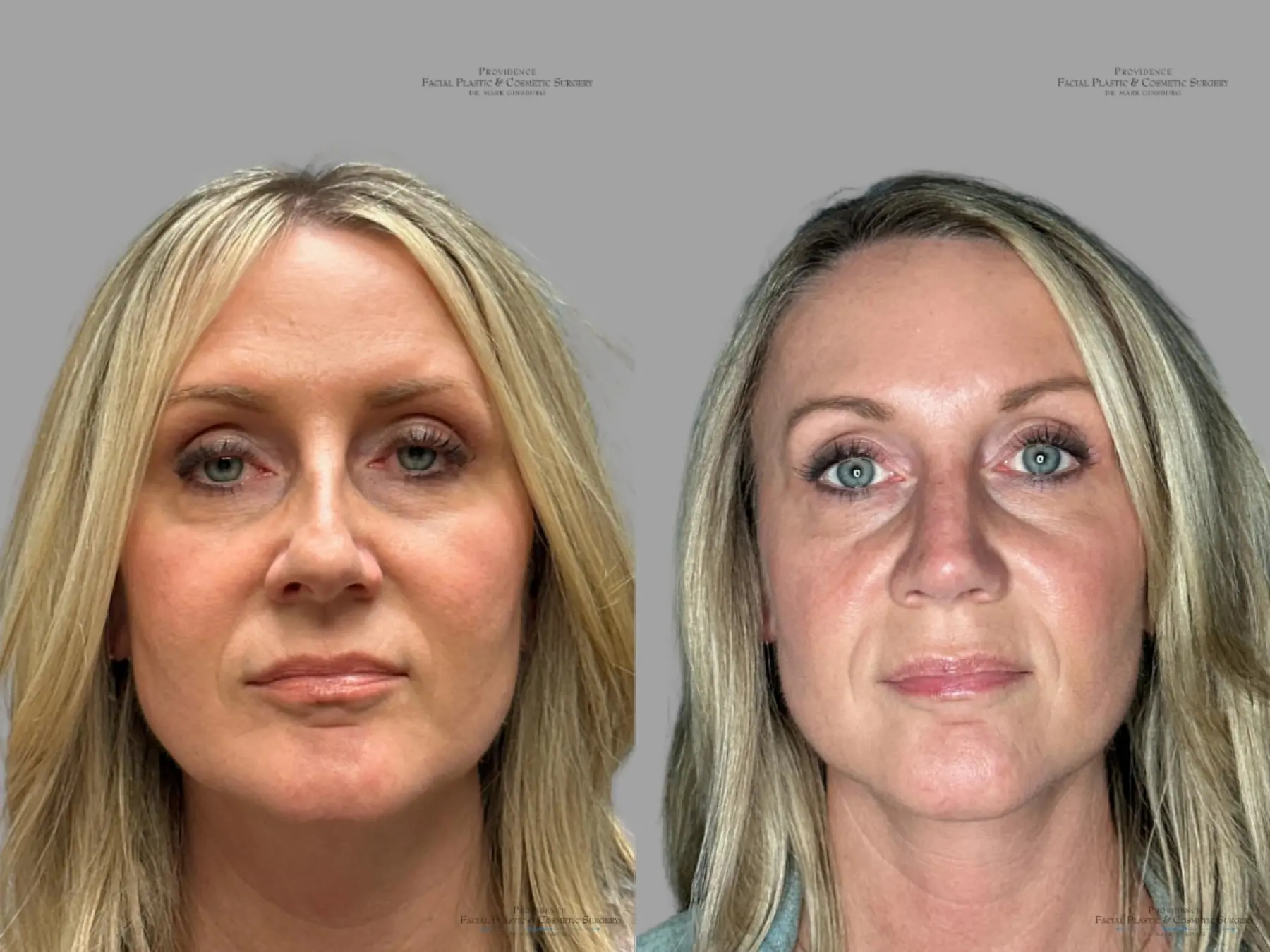 Rhinoplasty: Patient 38 - Before and After 1
