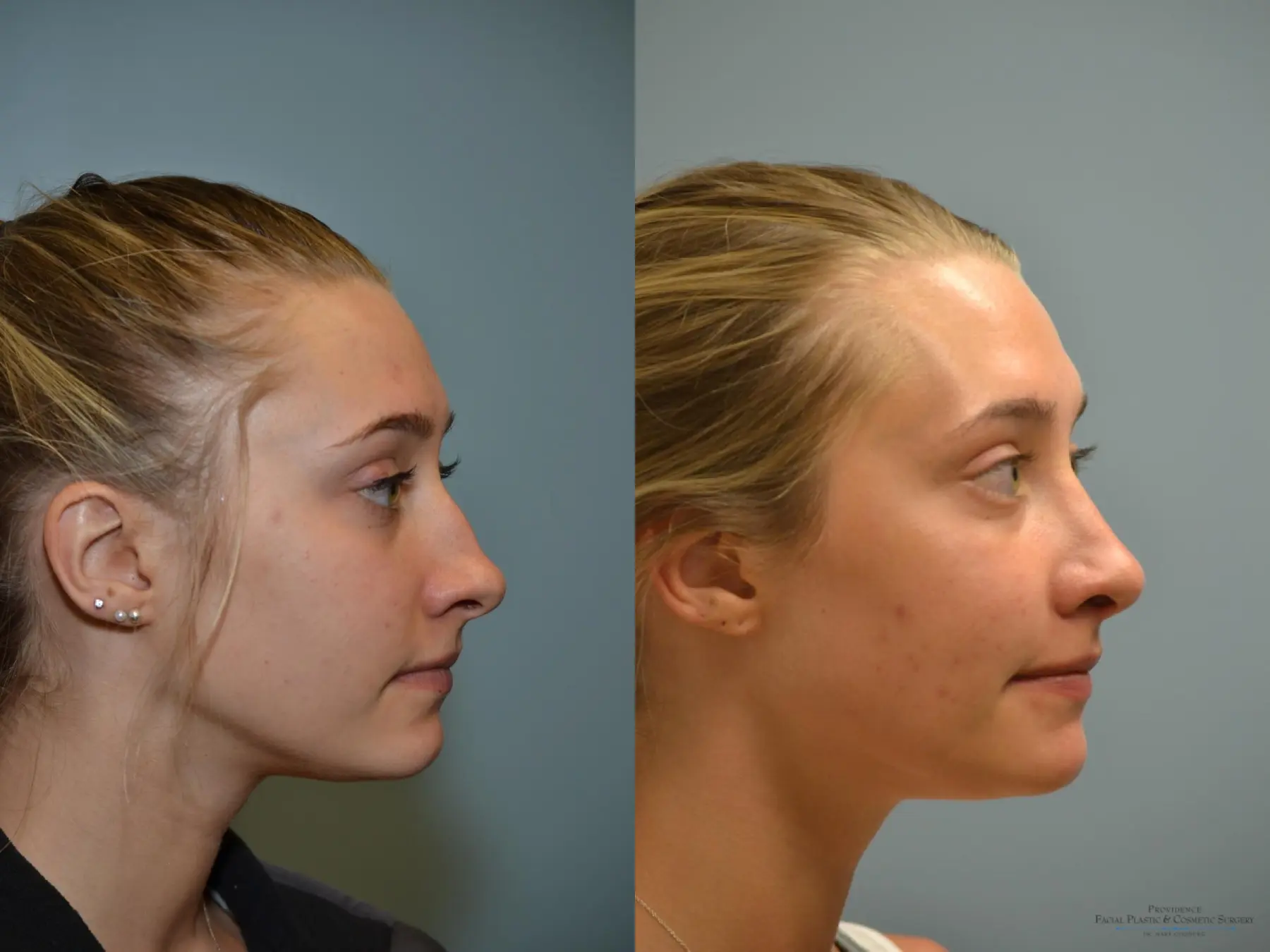 Rhinoplasty: Patient 19 - Before and After 3