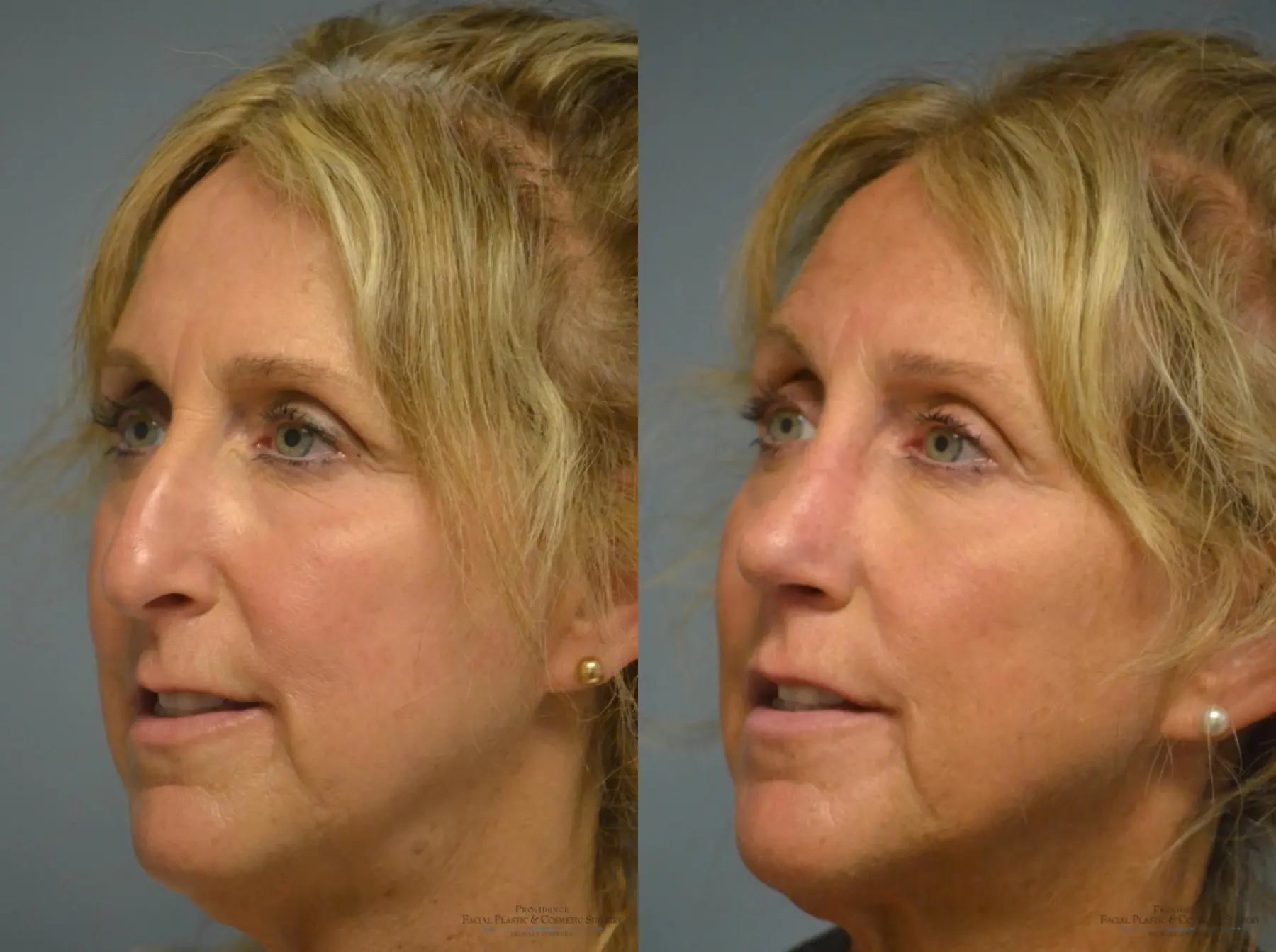 Rhinoplasty: Patient 14 - Before and After 2