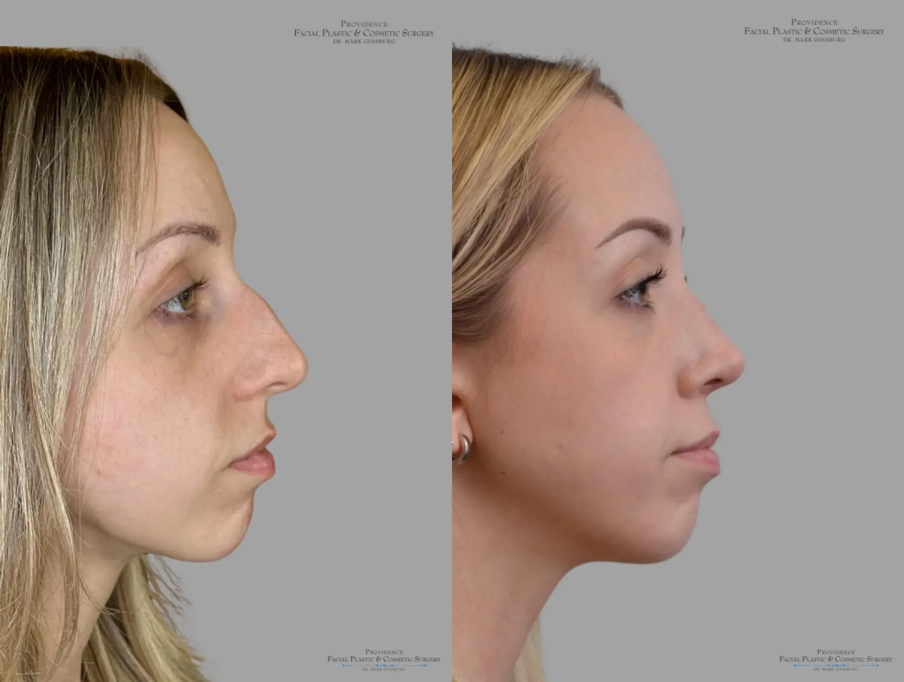 Rhinoplasty: Patient 42 - Before and After 3