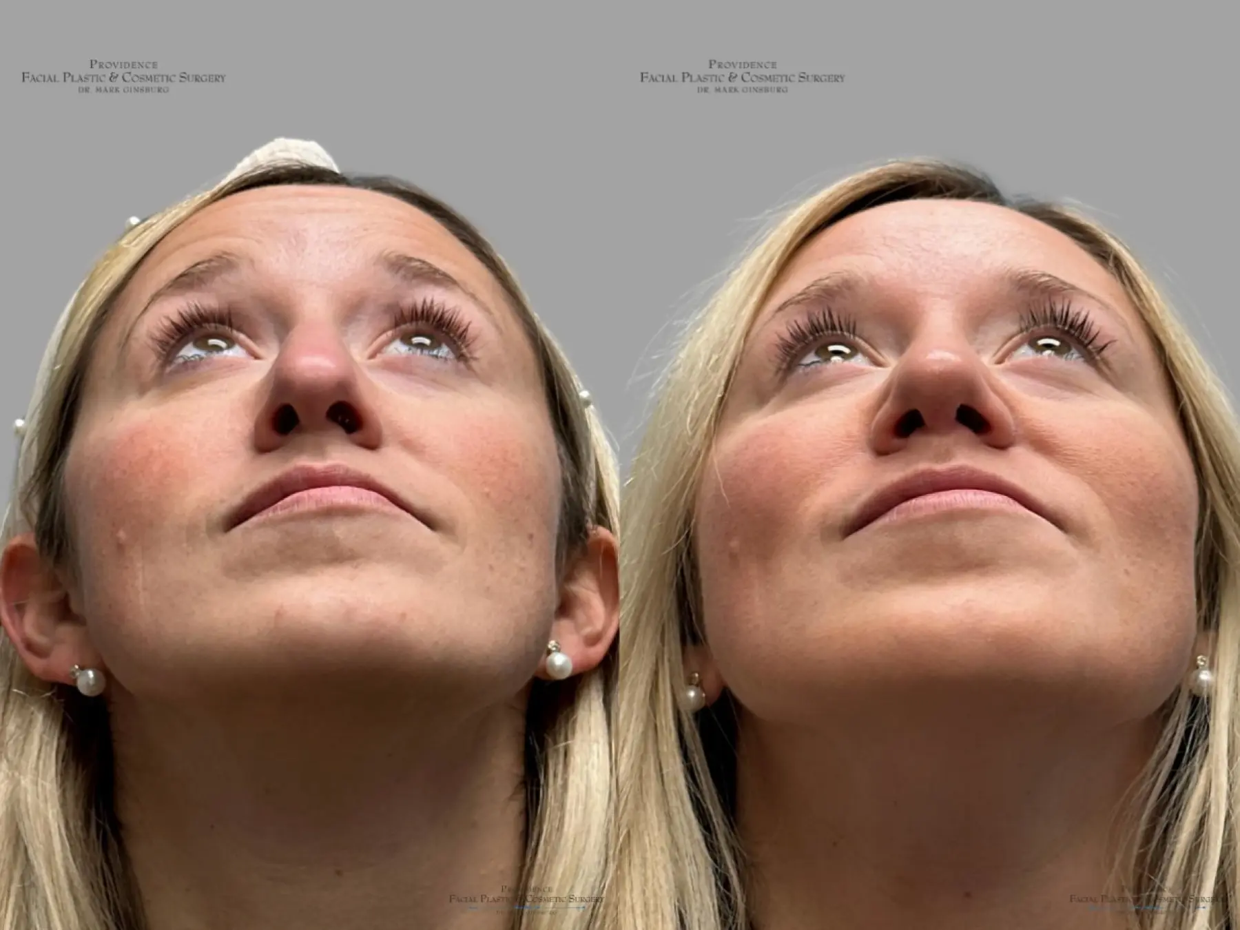 Rhinoplasty: Patient 34 - Before and After 2