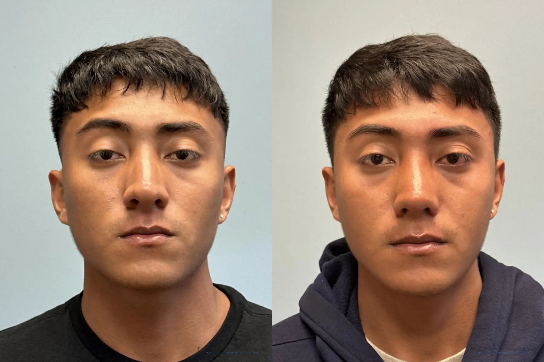 Rhinoplasty: Patient 38 - Before and After 1