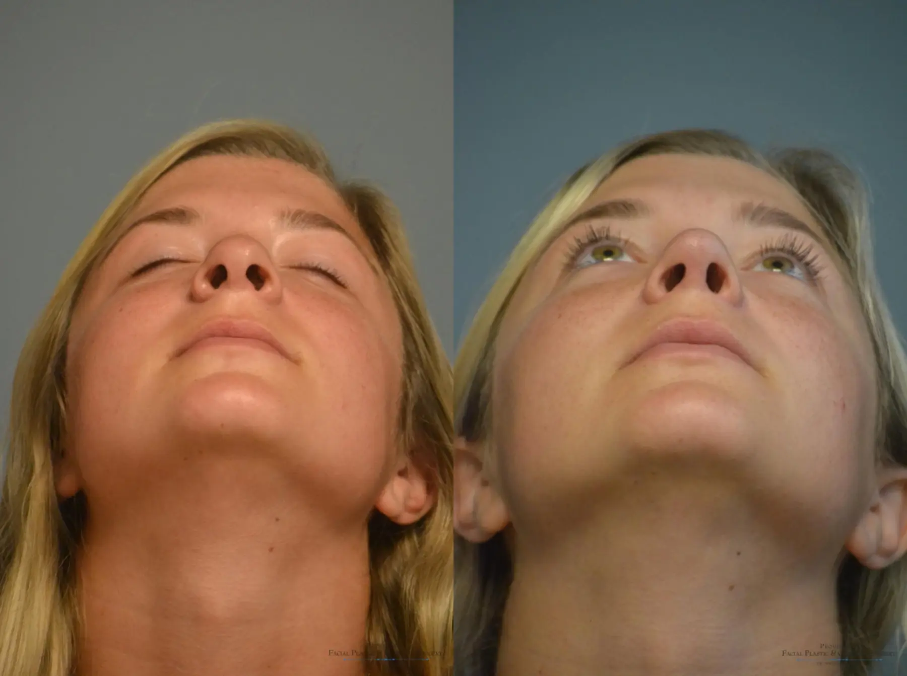 Rhinoplasty: Patient 5 - Before and After 5