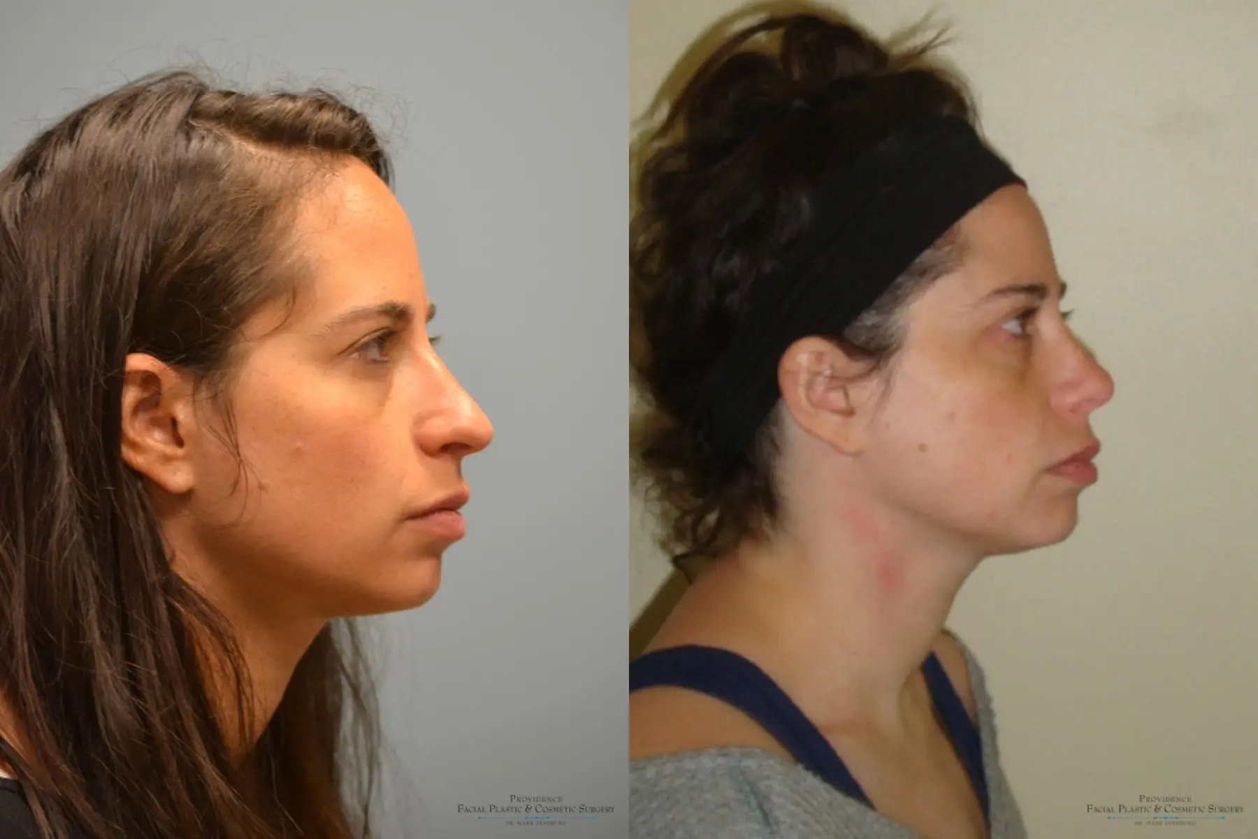 Rhinoplasty: Patient 3 - Before and After 3