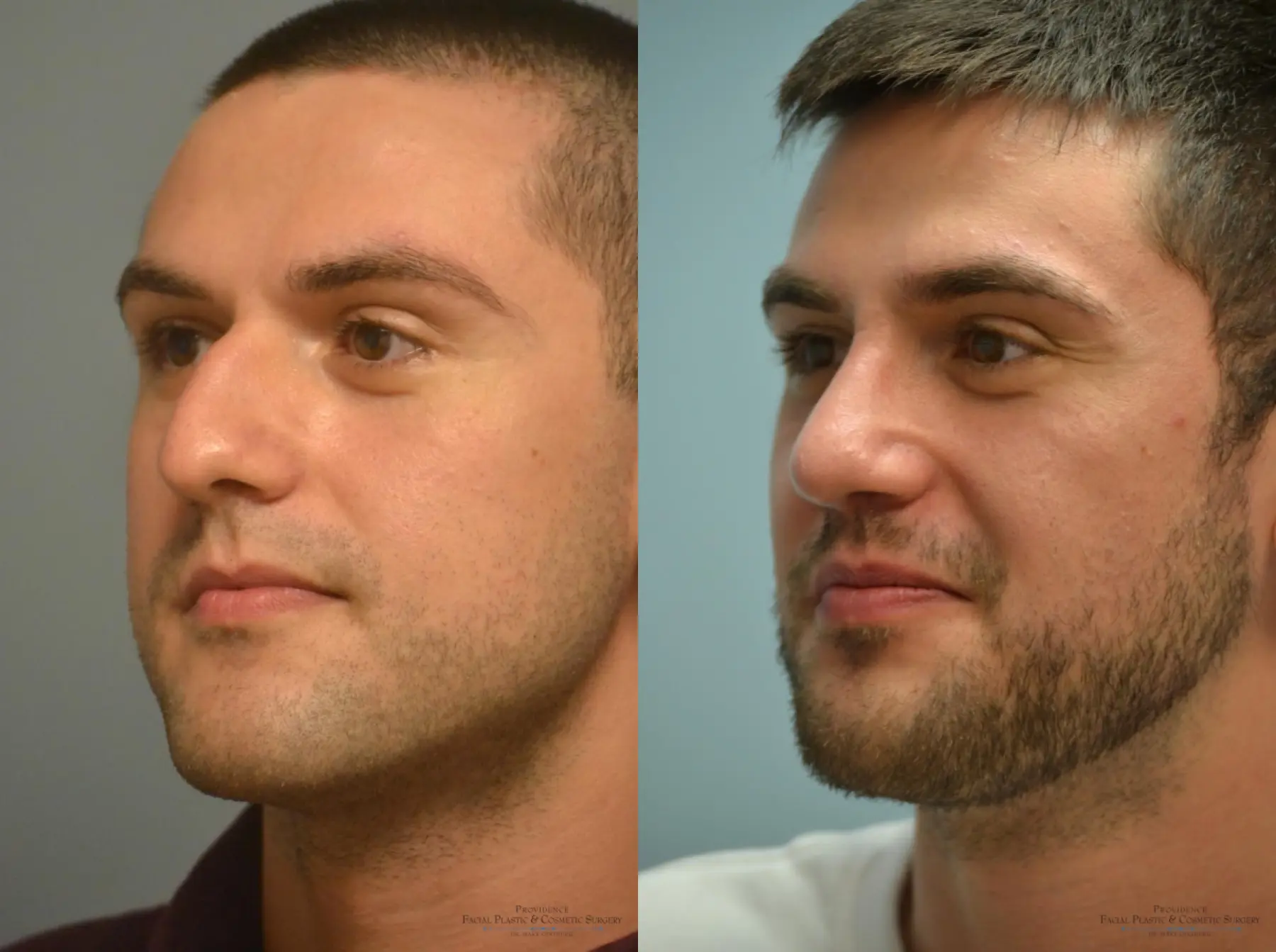 Rhinoplasty: Patient 2 - Before and After 2