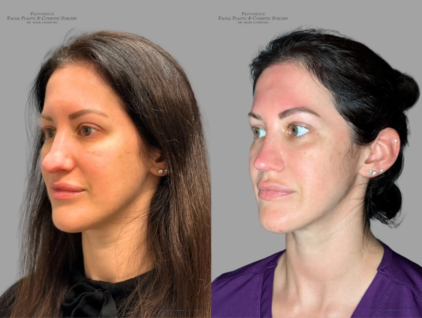 Rhinoplasty: Patient 33 - Before and After 5