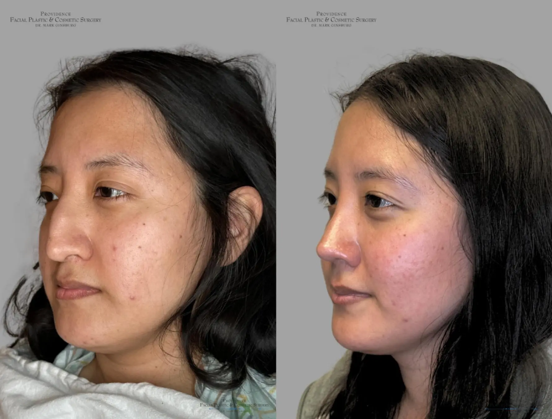 Rhinoplasty: Patient 31 - Before and After 4