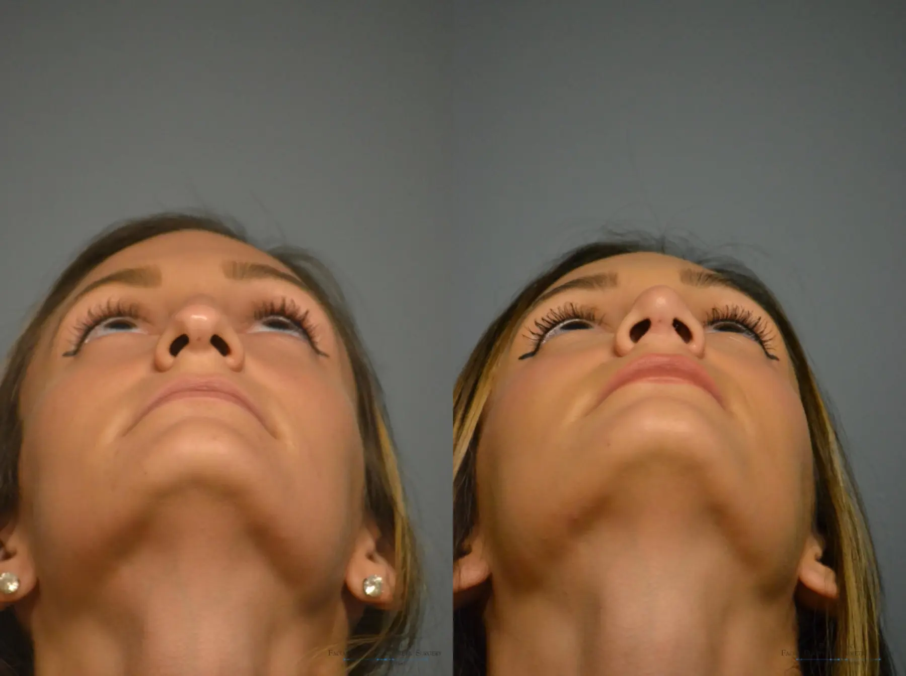 Rhinoplasty: Patient 1 - Before and After 5