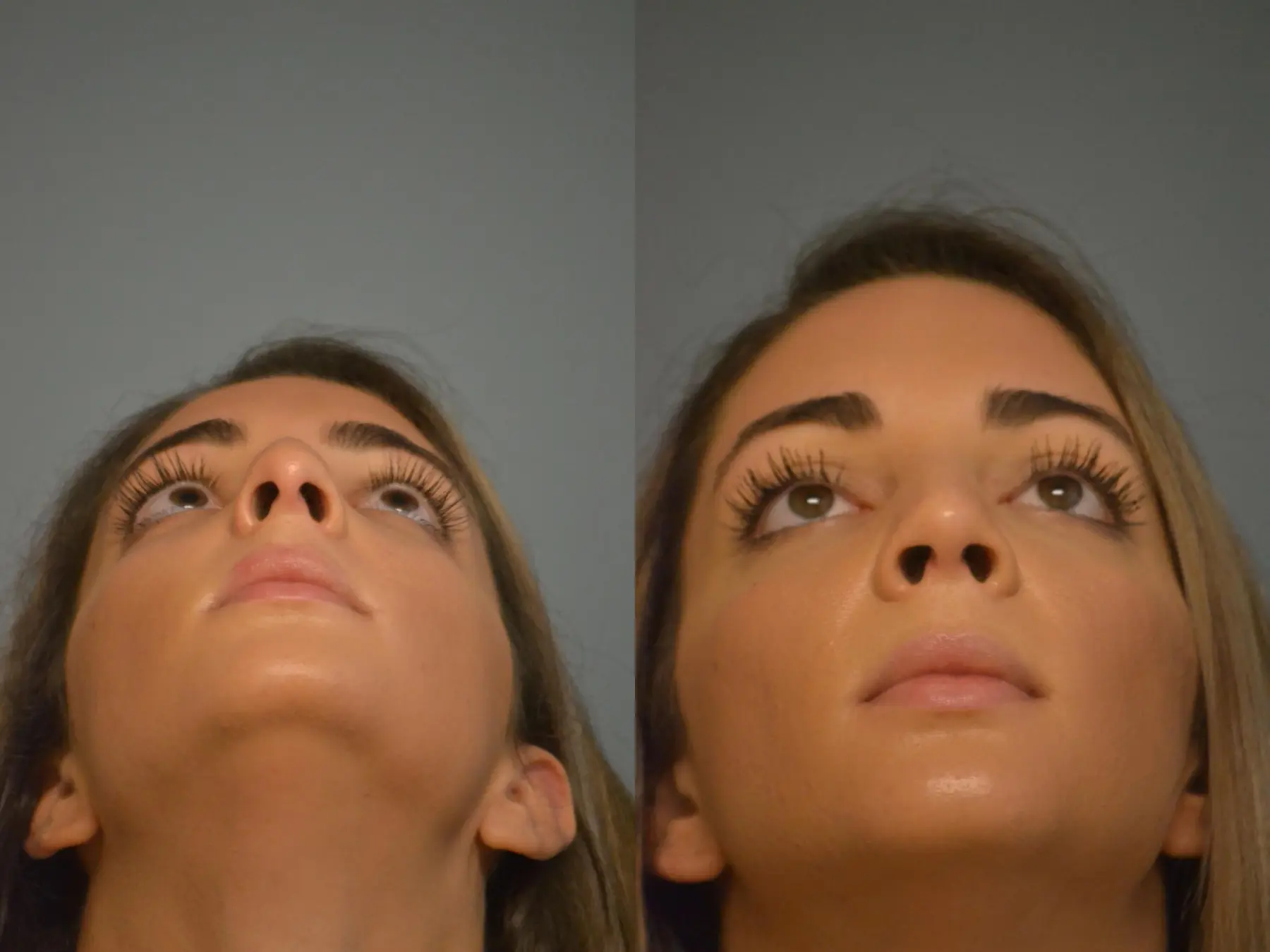 Rhinoplasty: Patient 24 - Before and After 5