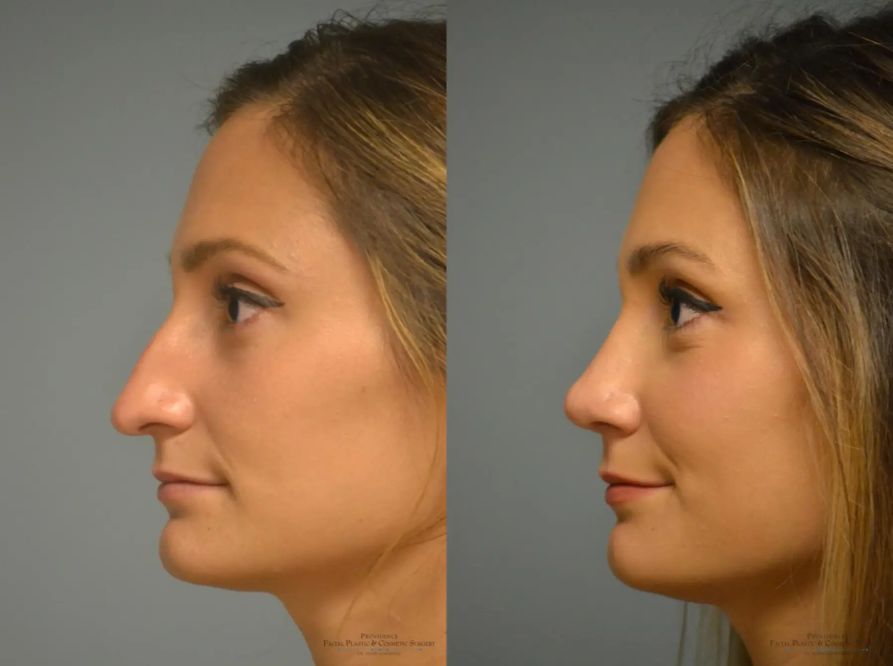 Rhinoplasty: Patient 1 - Before and After 3