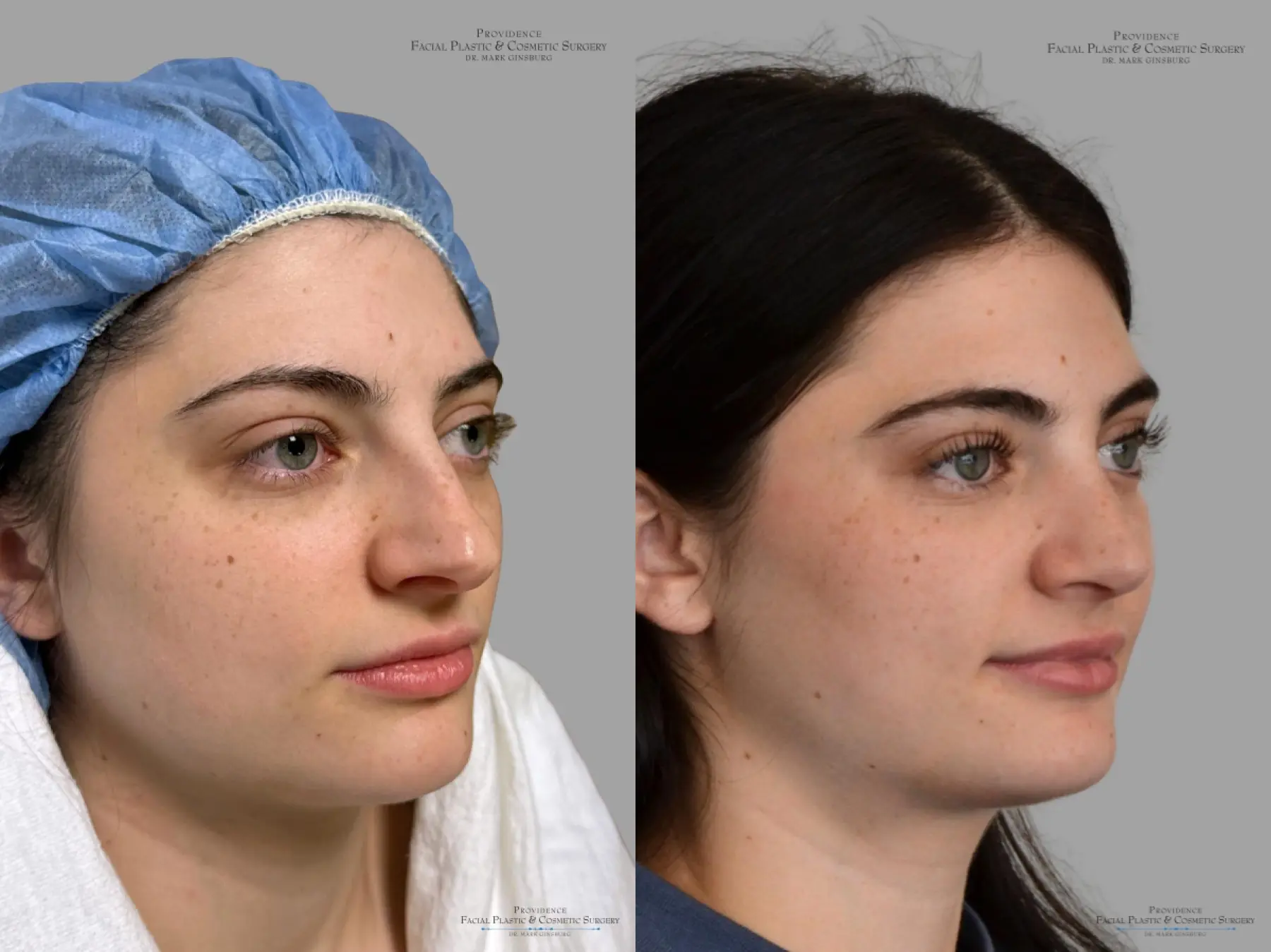 Rhinoplasty: Patient 43 - Before and After 2