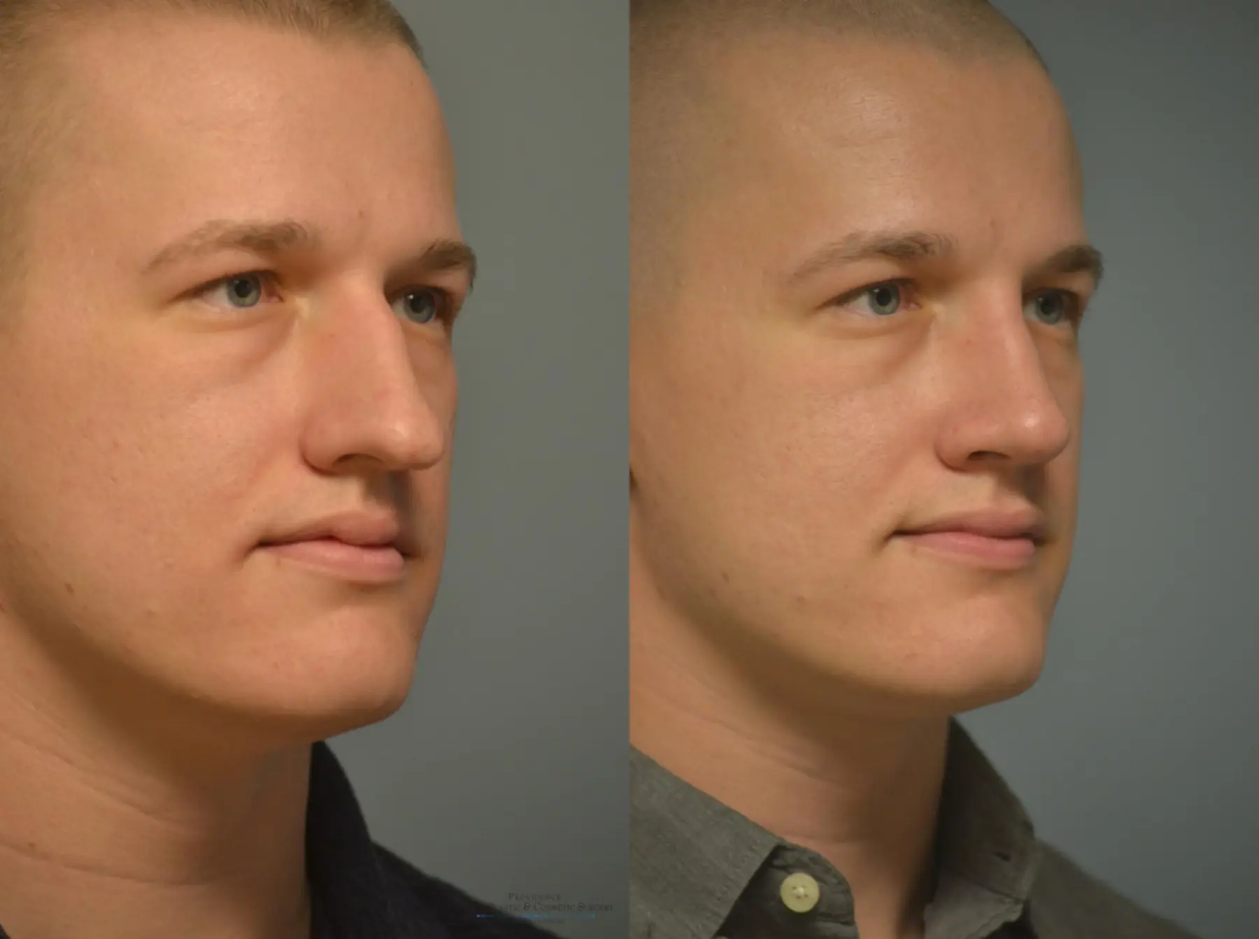 Rhinoplasty: Patient 20 - Before and After 2