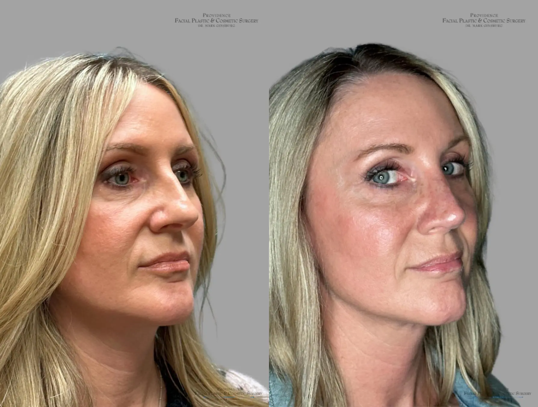 Rhinoplasty: Patient 38 - Before and After 3