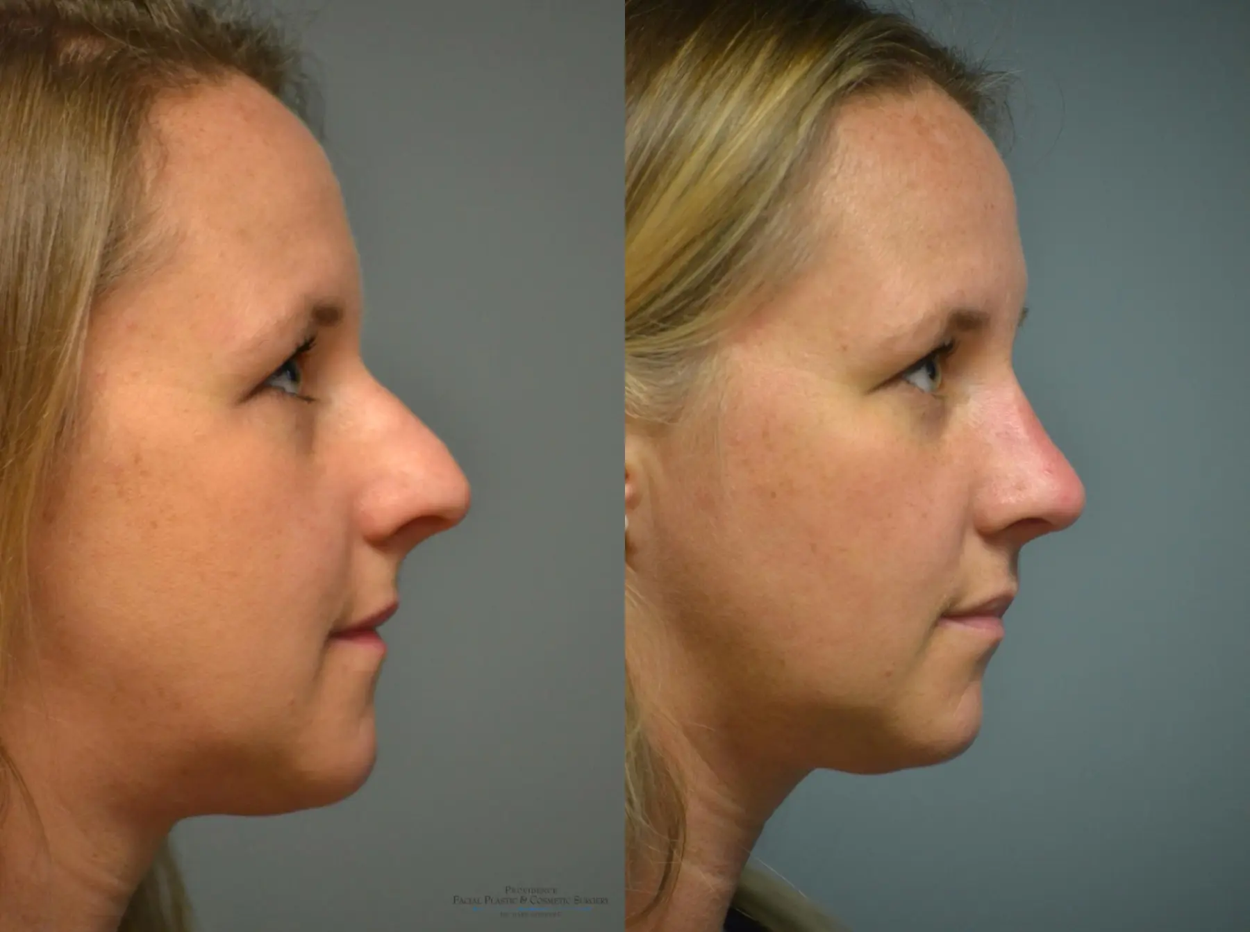 Rhinoplasty: Patient 6 - Before and After 4