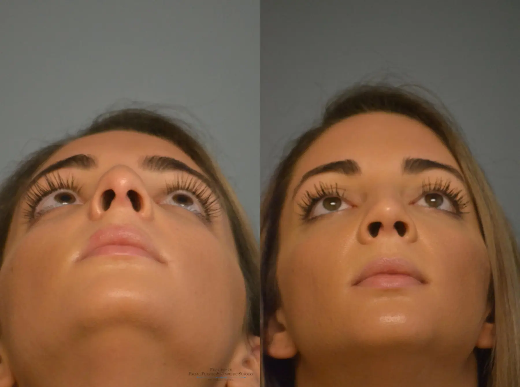 Rhinoplasty: Patient 10 - Before and After 5