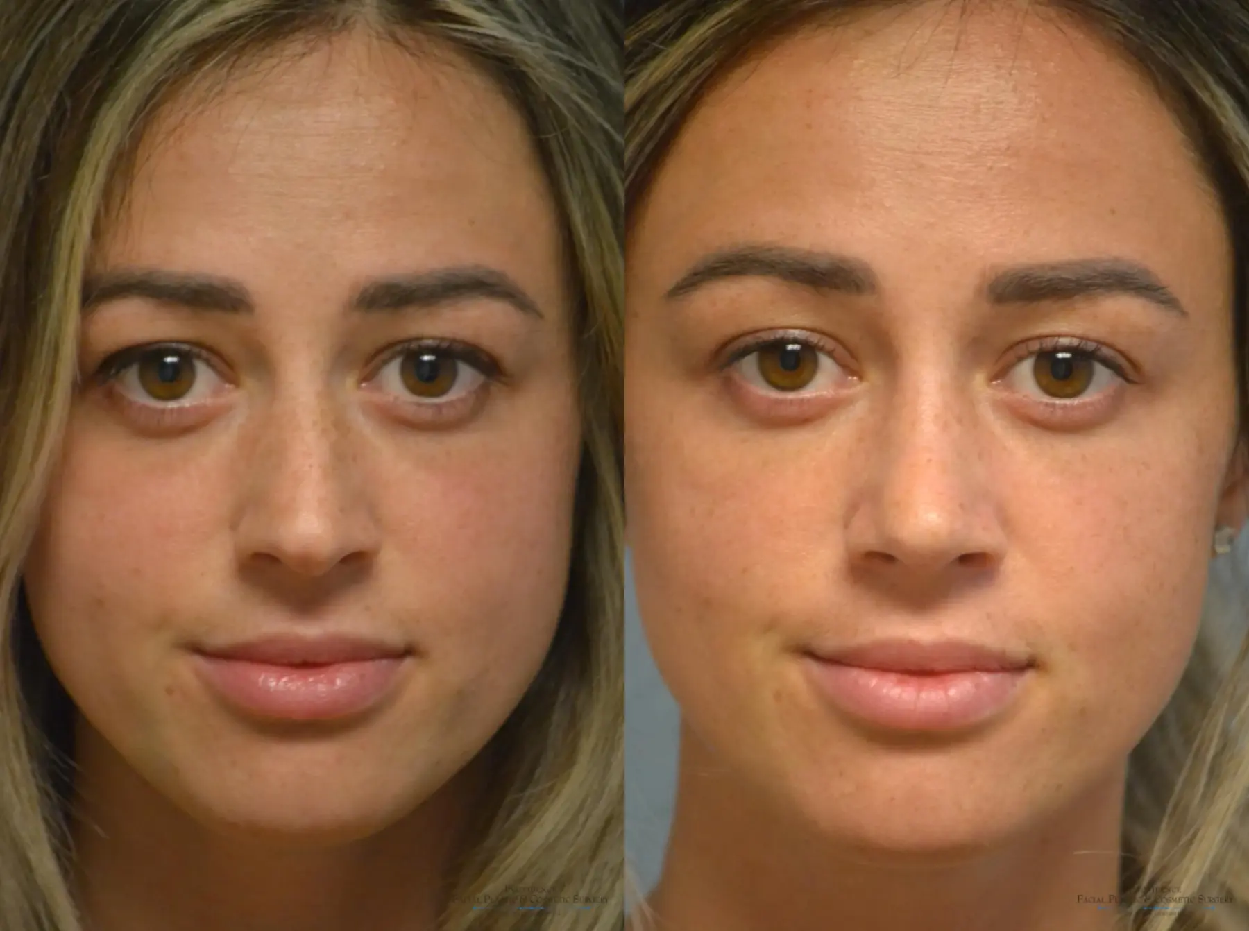 Rhinoplasty: Patient 9 - Before and After  