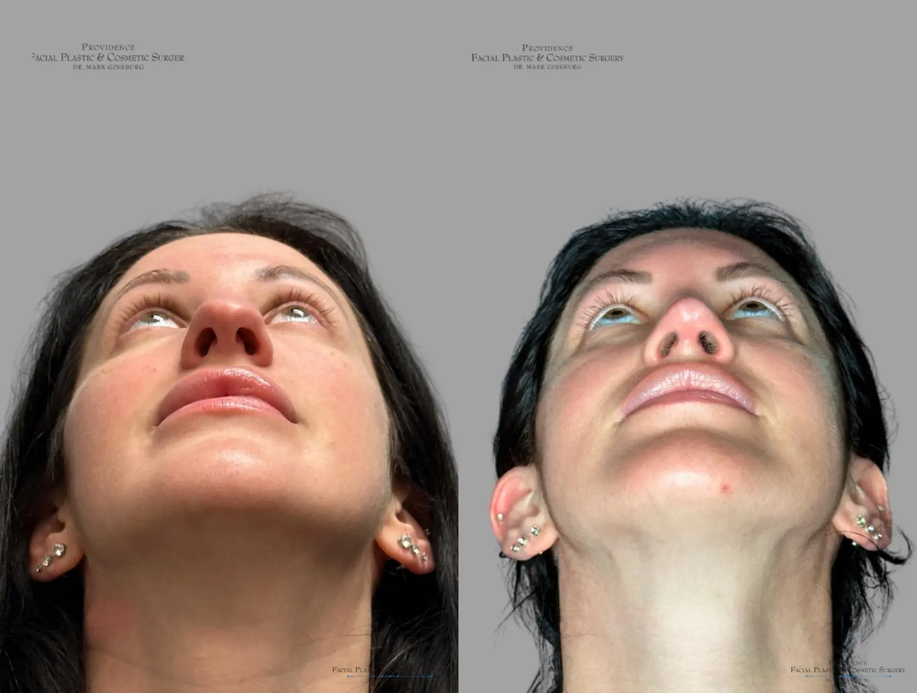 Rhinoplasty: Patient 33 - Before and After 2