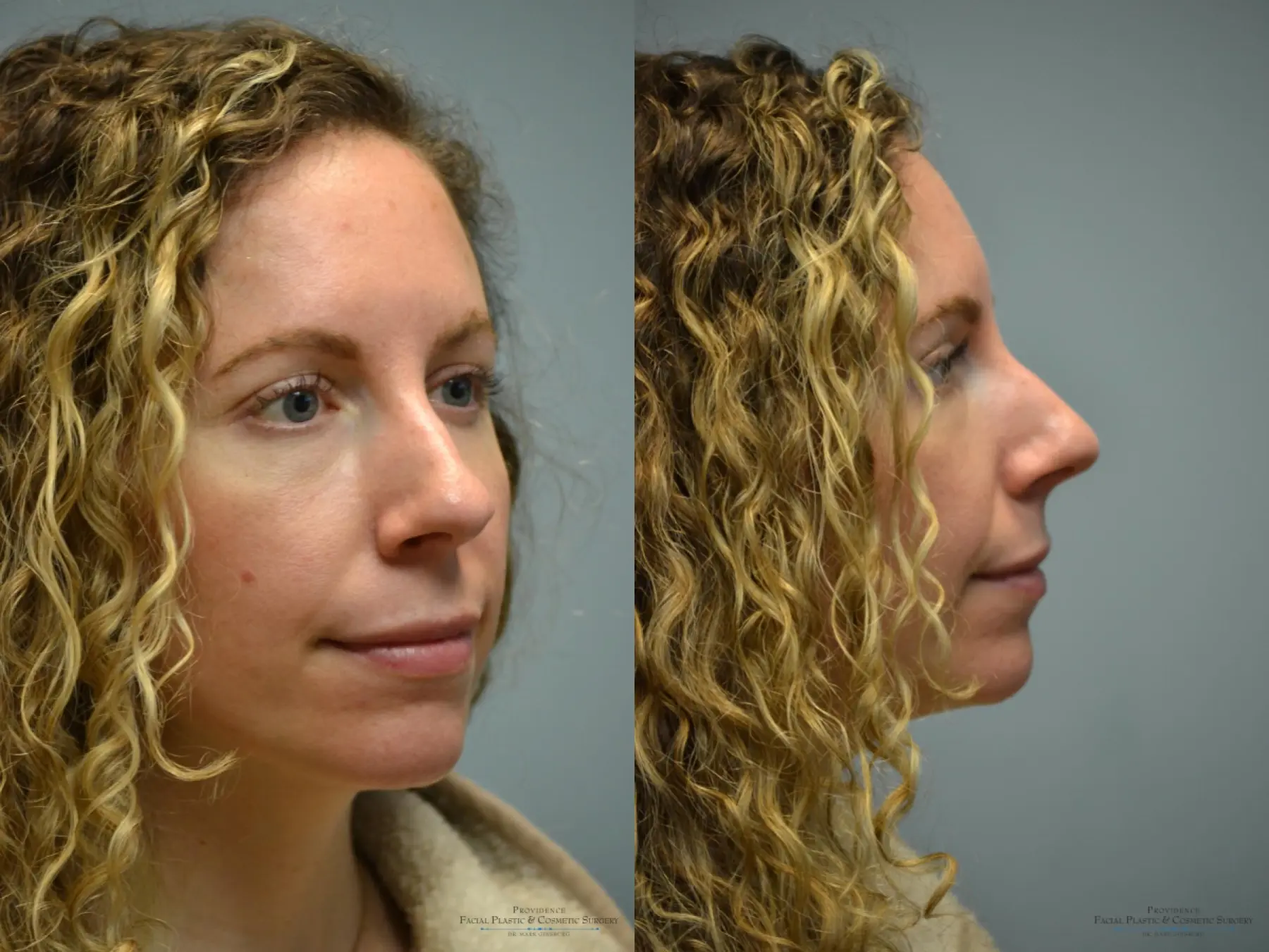 Rhinoplasty: Patient 35 - Before and After 1
