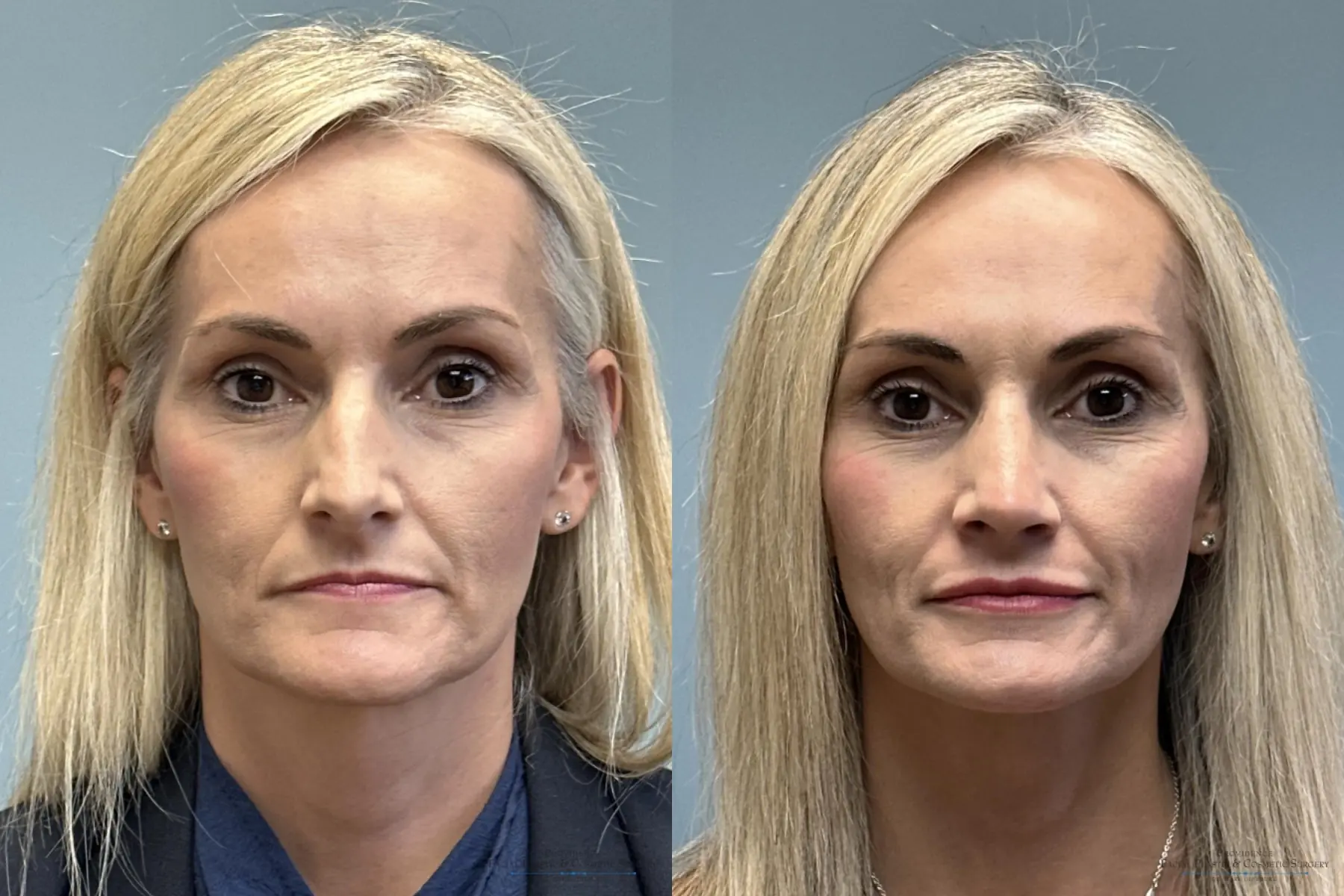 Rhinoplasty: Patient 37 - Before and After 1