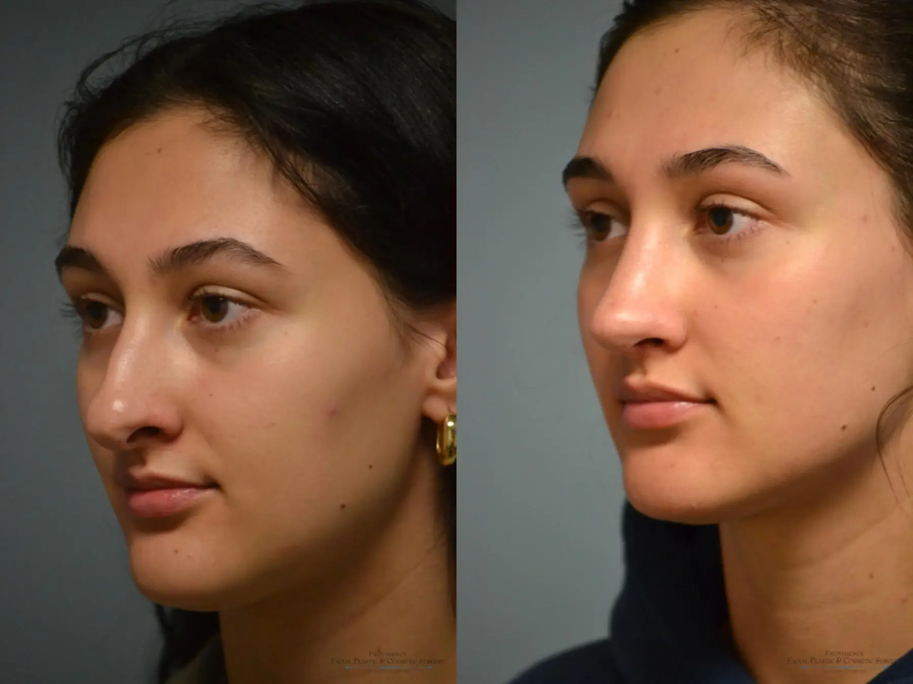 Rhinoplasty: Patient 43 - Before and After 1