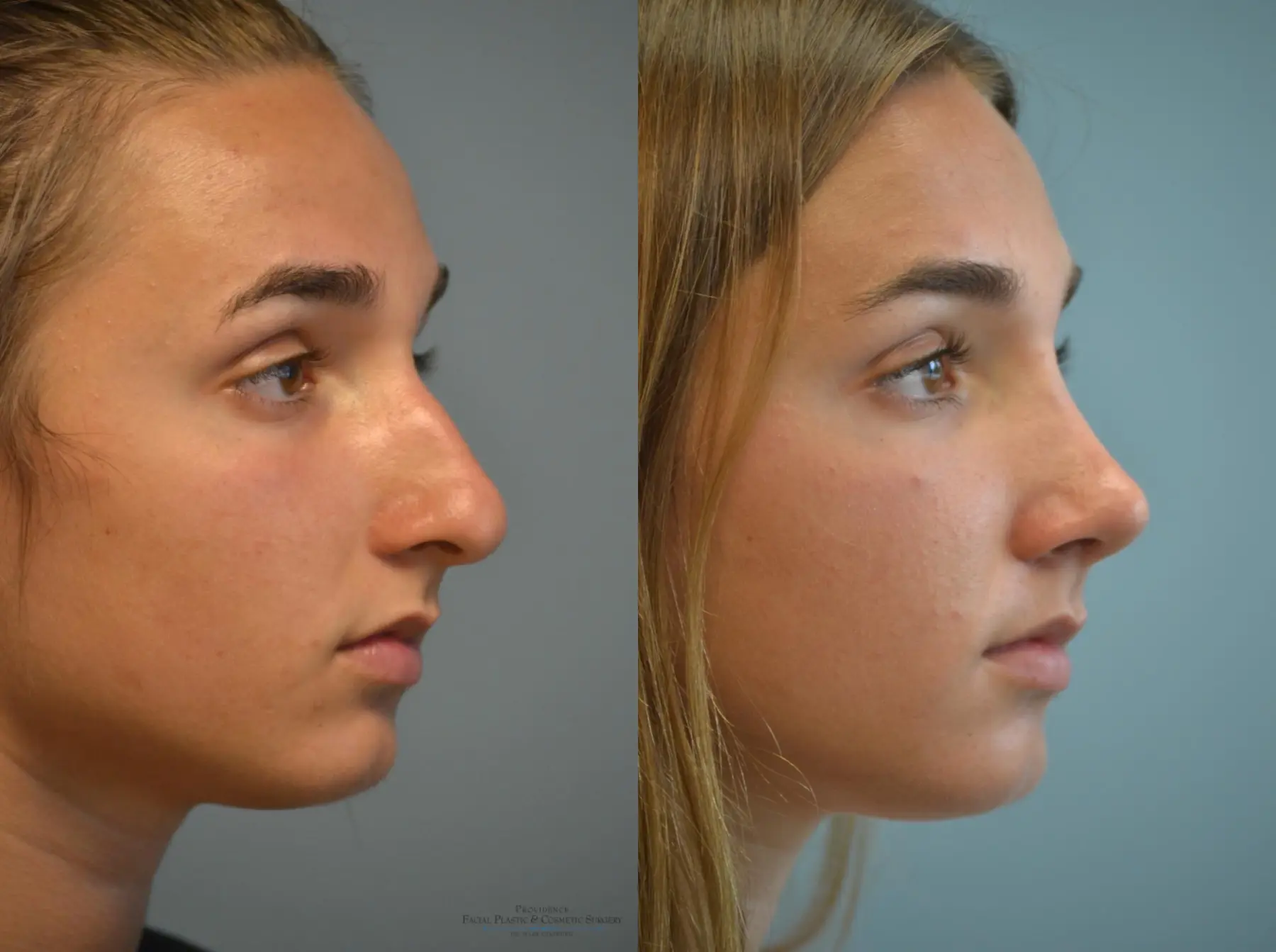 Rhinoplasty: Patient 8 - Before and After 4